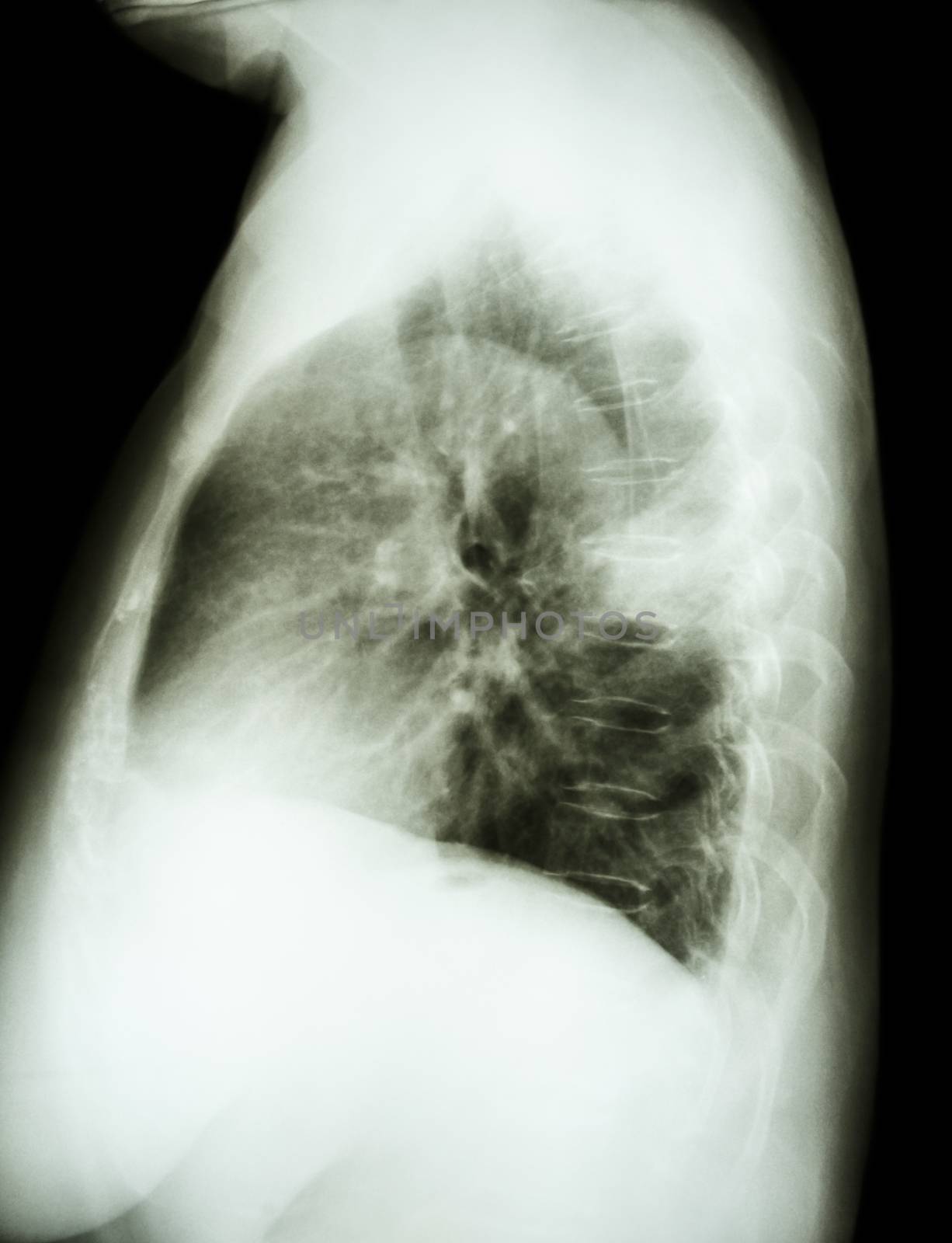 X-ray chest lateral of lung cancer patient