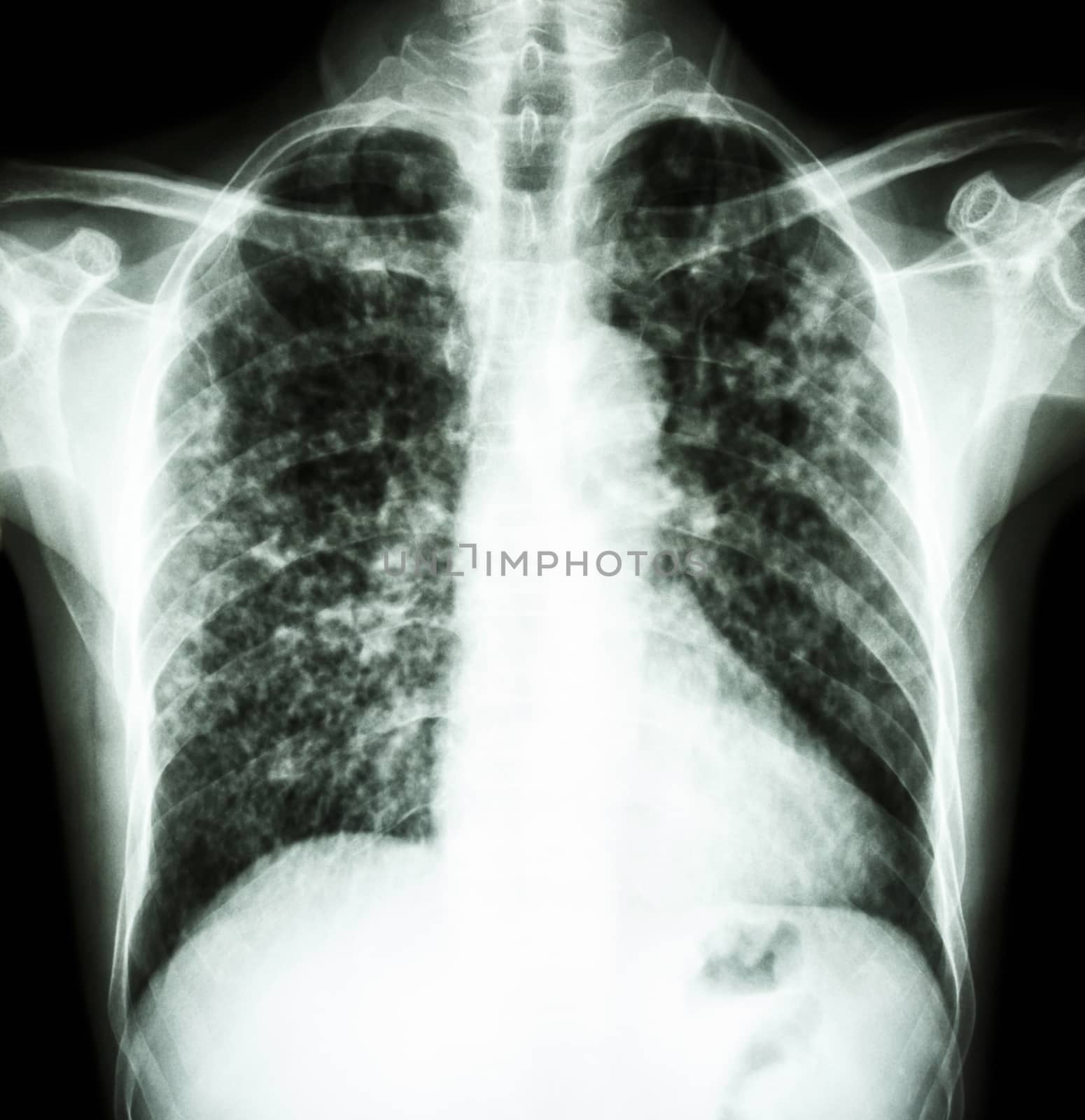 film chest x-ray show interstitial infiltrate both lung due to Mycobacterium tuberculosis infection (Pulmonary Tuberculosis)