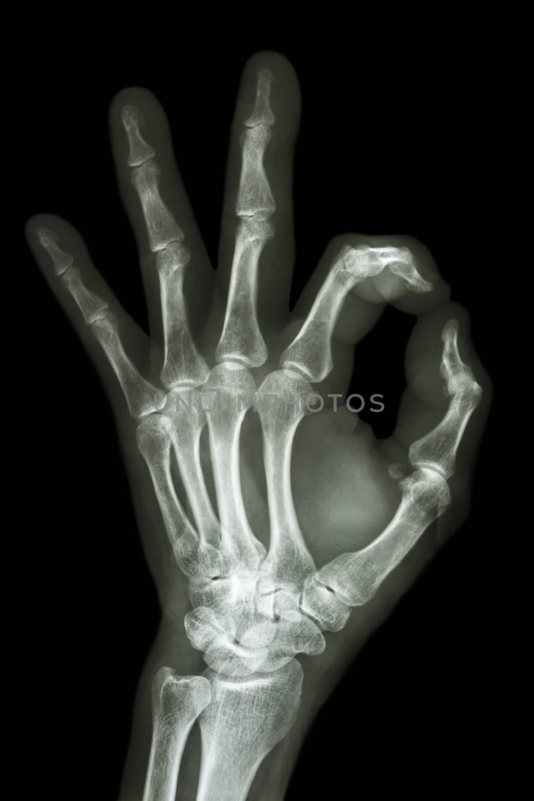 X-ray hand with OK symbol