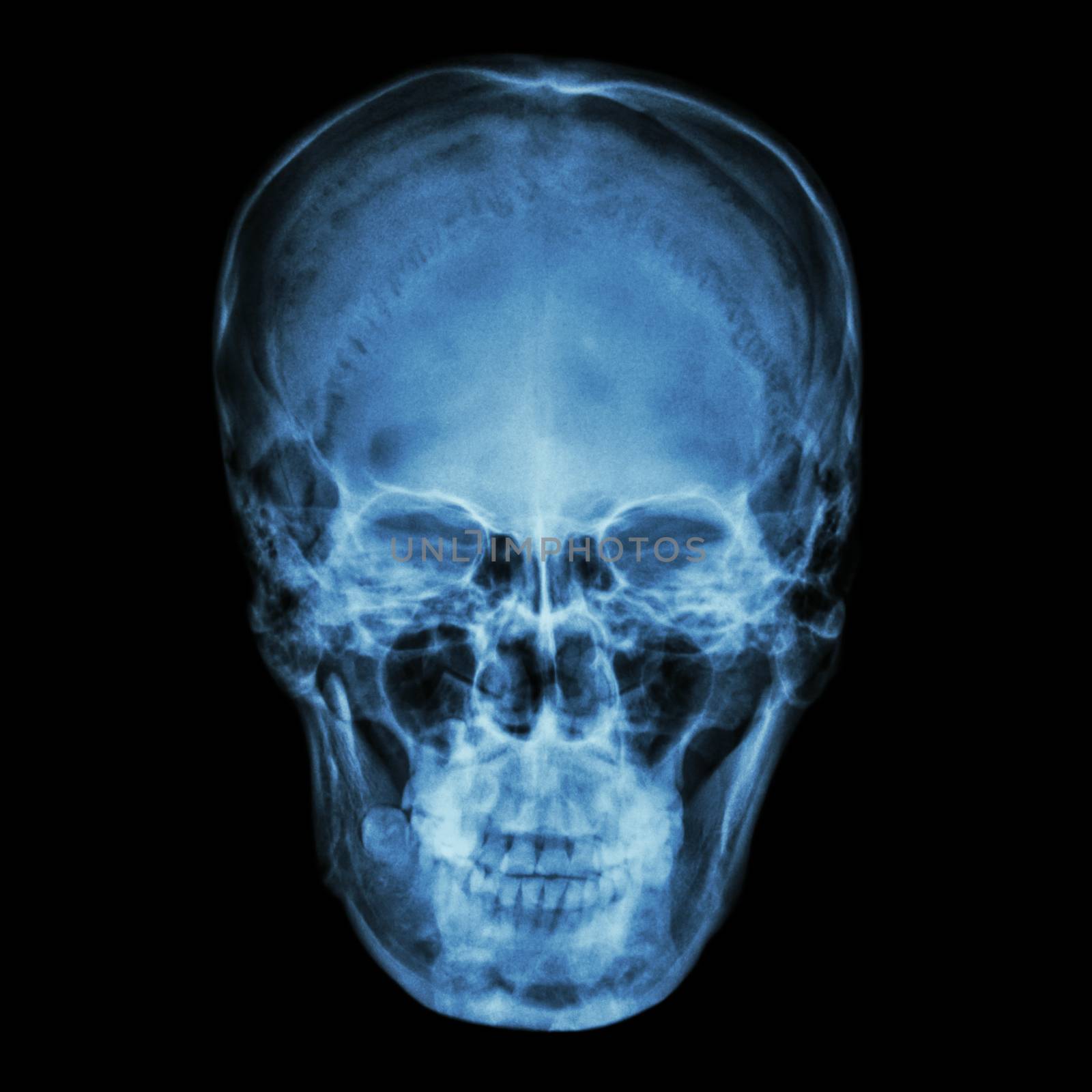 X-ray normal asian skull (Thai people) by stockdevil
