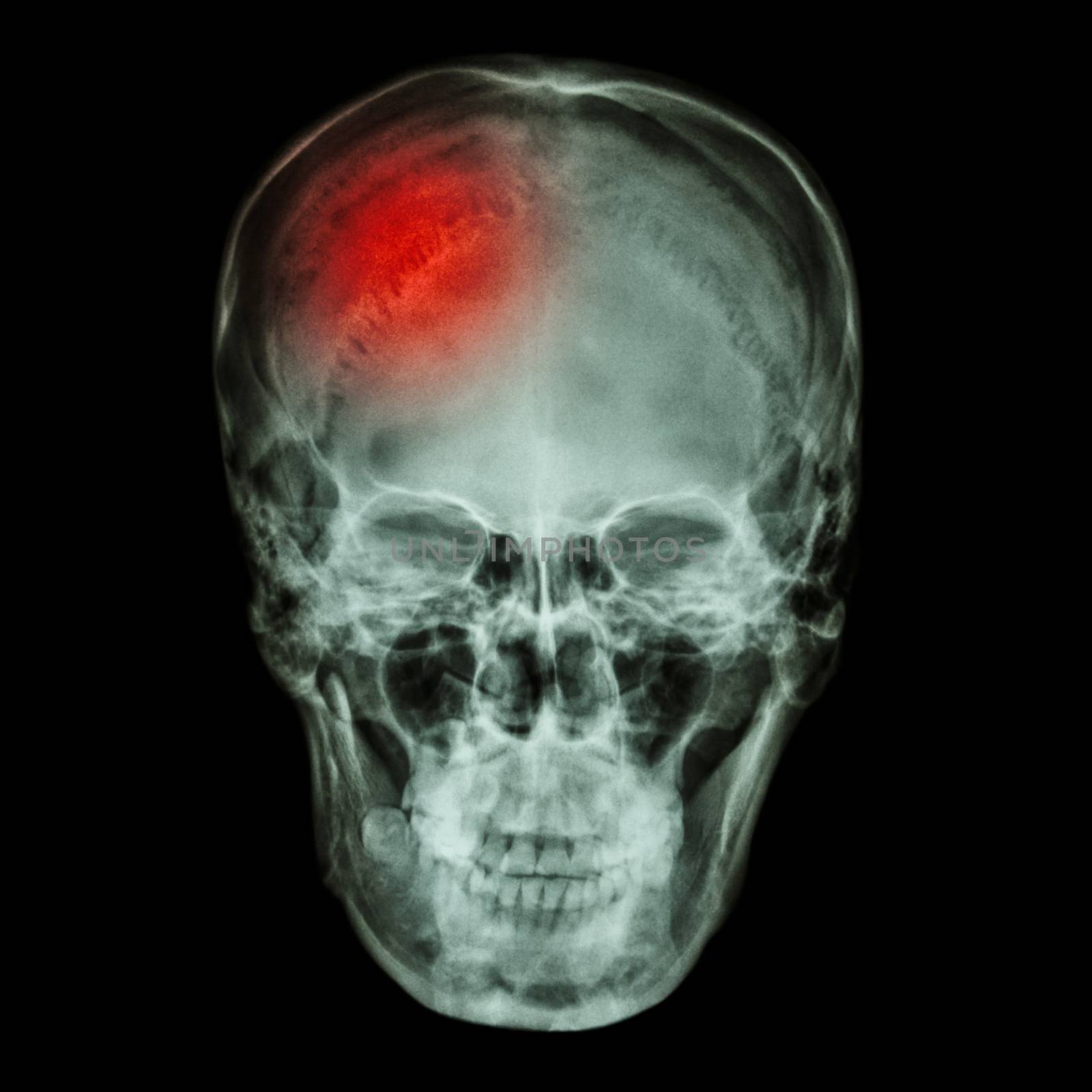 X-ray asian skull (Thai people) and headache by stockdevil