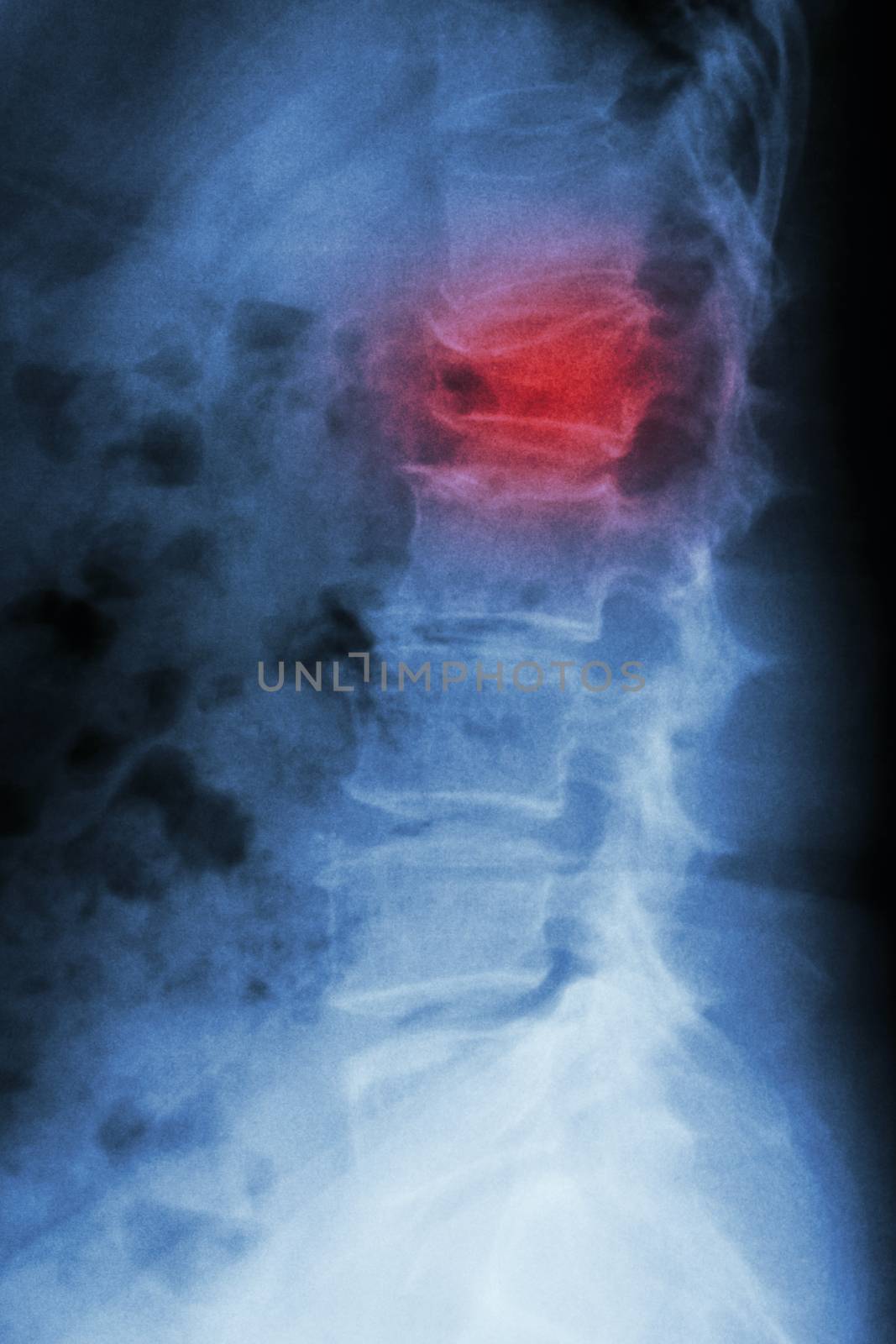 Film x-ray lumbar spine lateral : show burst fracture at lumbar spine (collapse at body of lumbar spine)