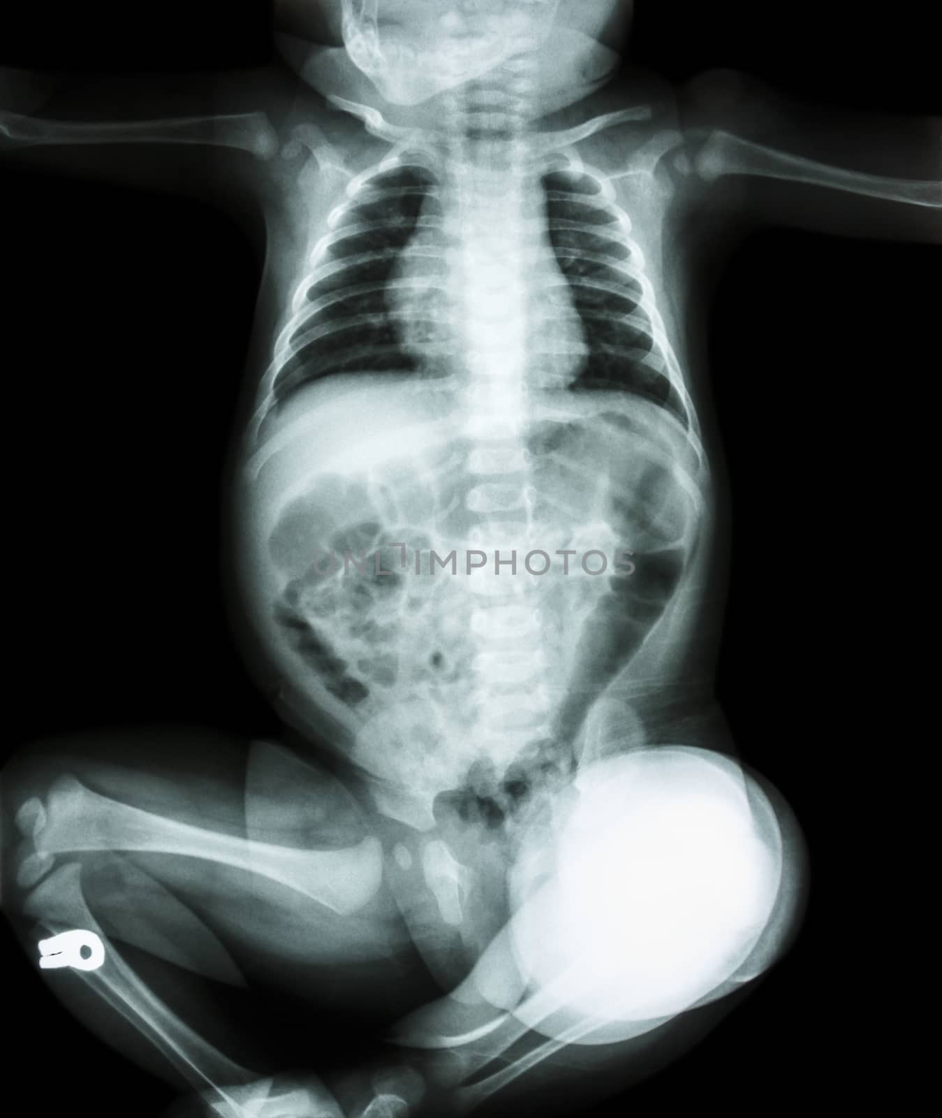 X-ray child is sitting