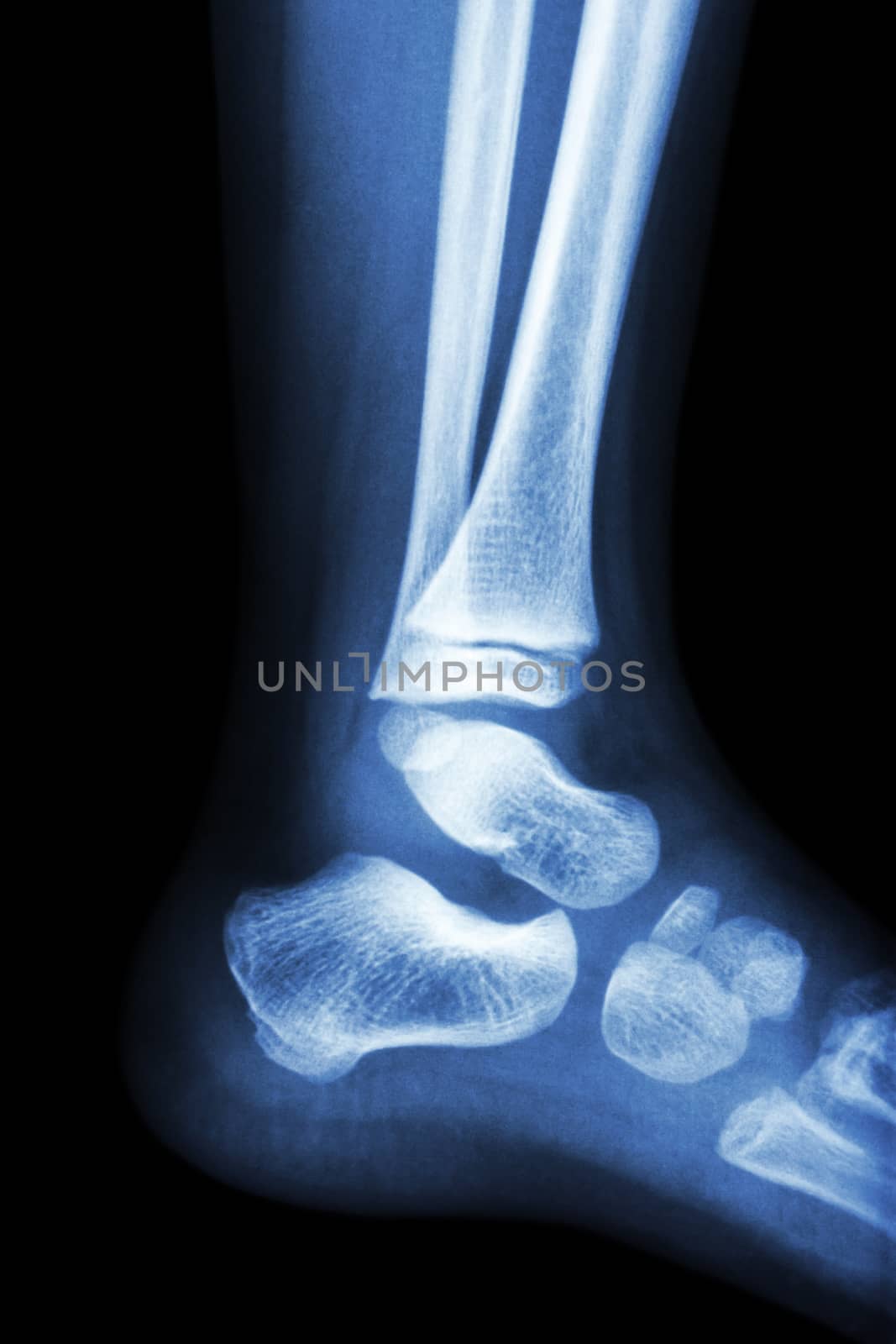 Film x-ray normal child's ankle