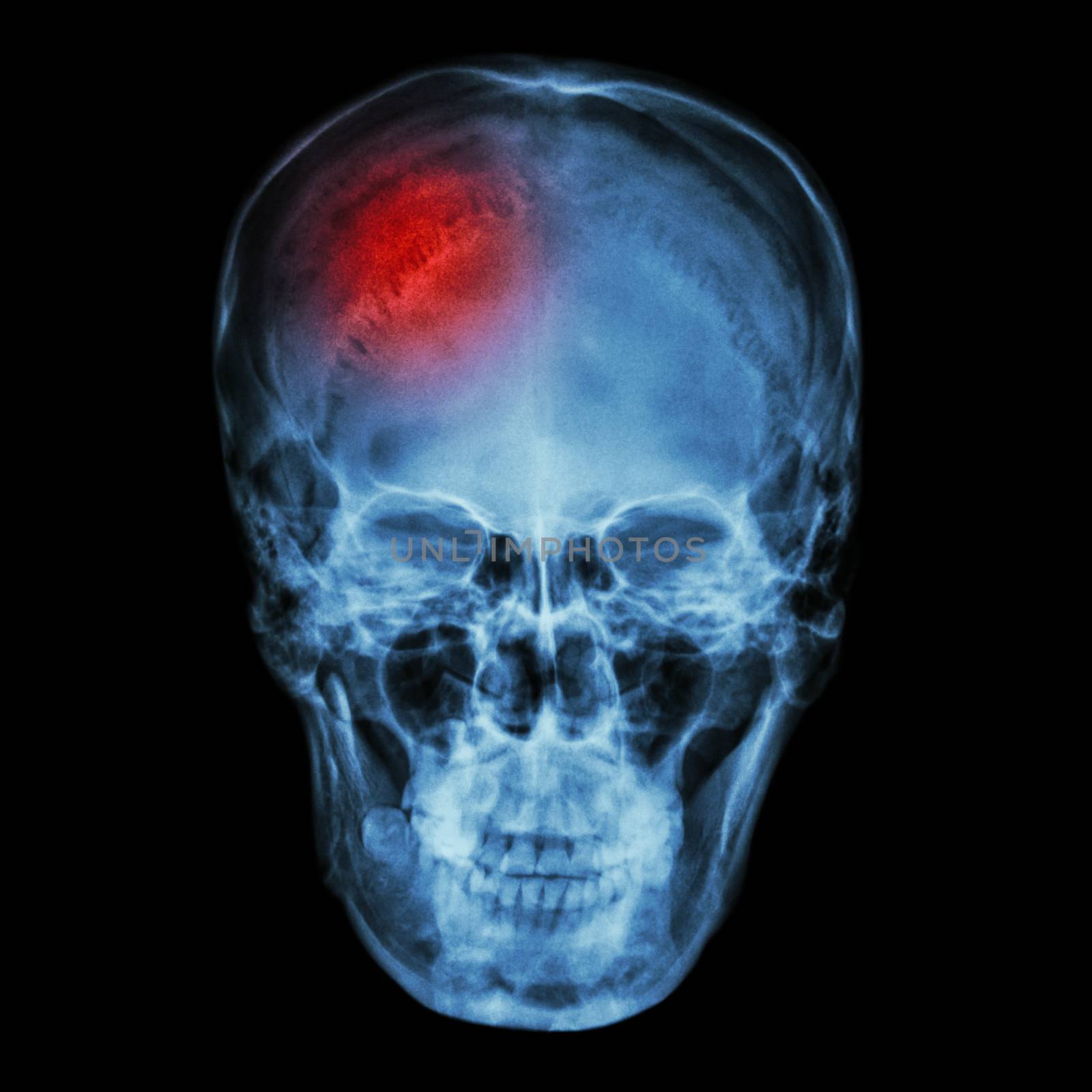 X-ray asian skull (Thai people) and headache by stockdevil