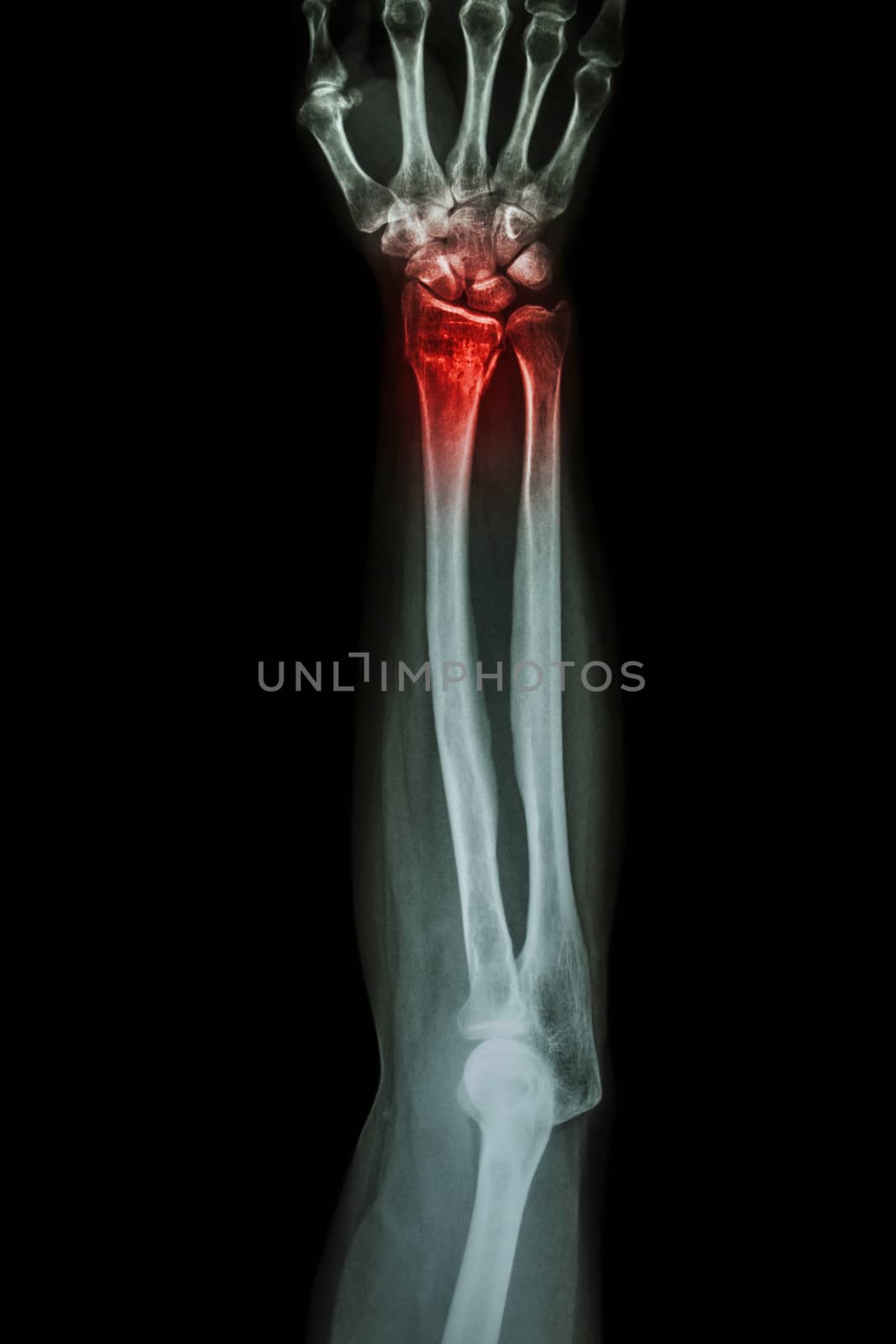 Fracture distal radius (wrist bone) ,(Colles' fracture)