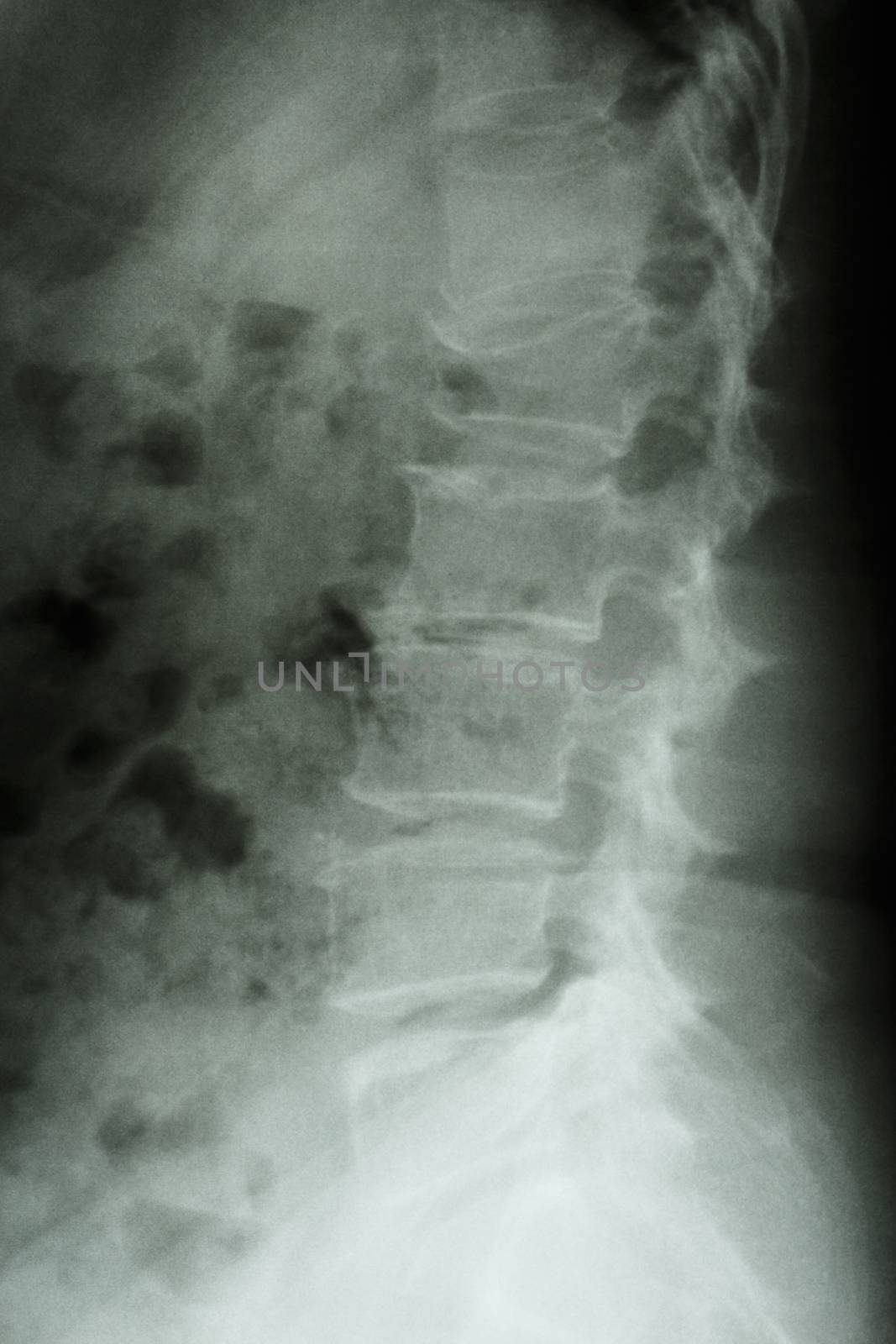 Film x-ray lumbar spine lateral : show burst fracture at lumbar spine (collapse at body of lumbar spine)