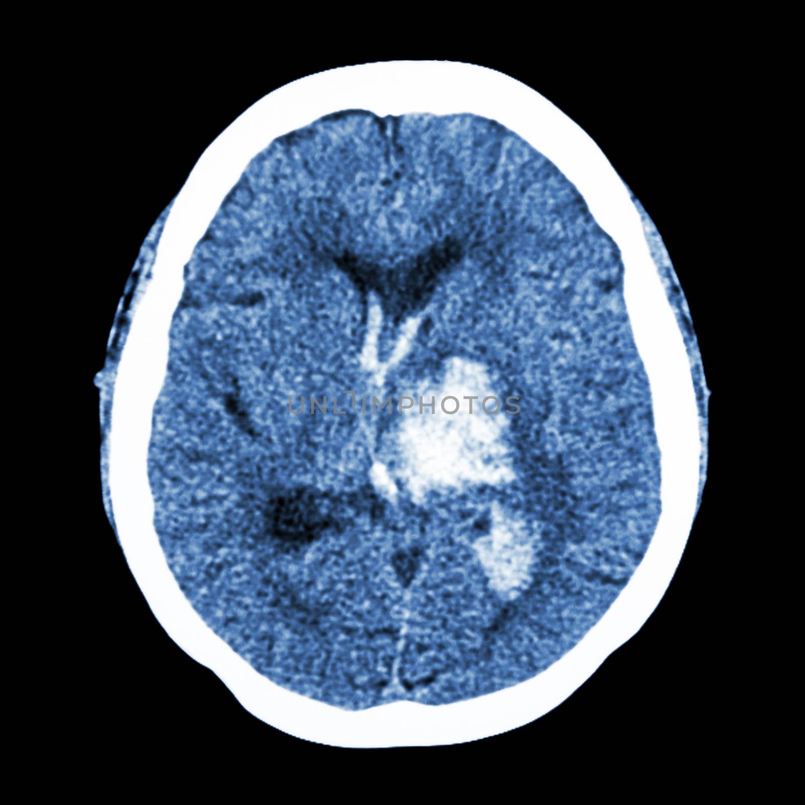 CT brain : show left thalamic hemorrhage (Hemorrhagic stroke) by stockdevil