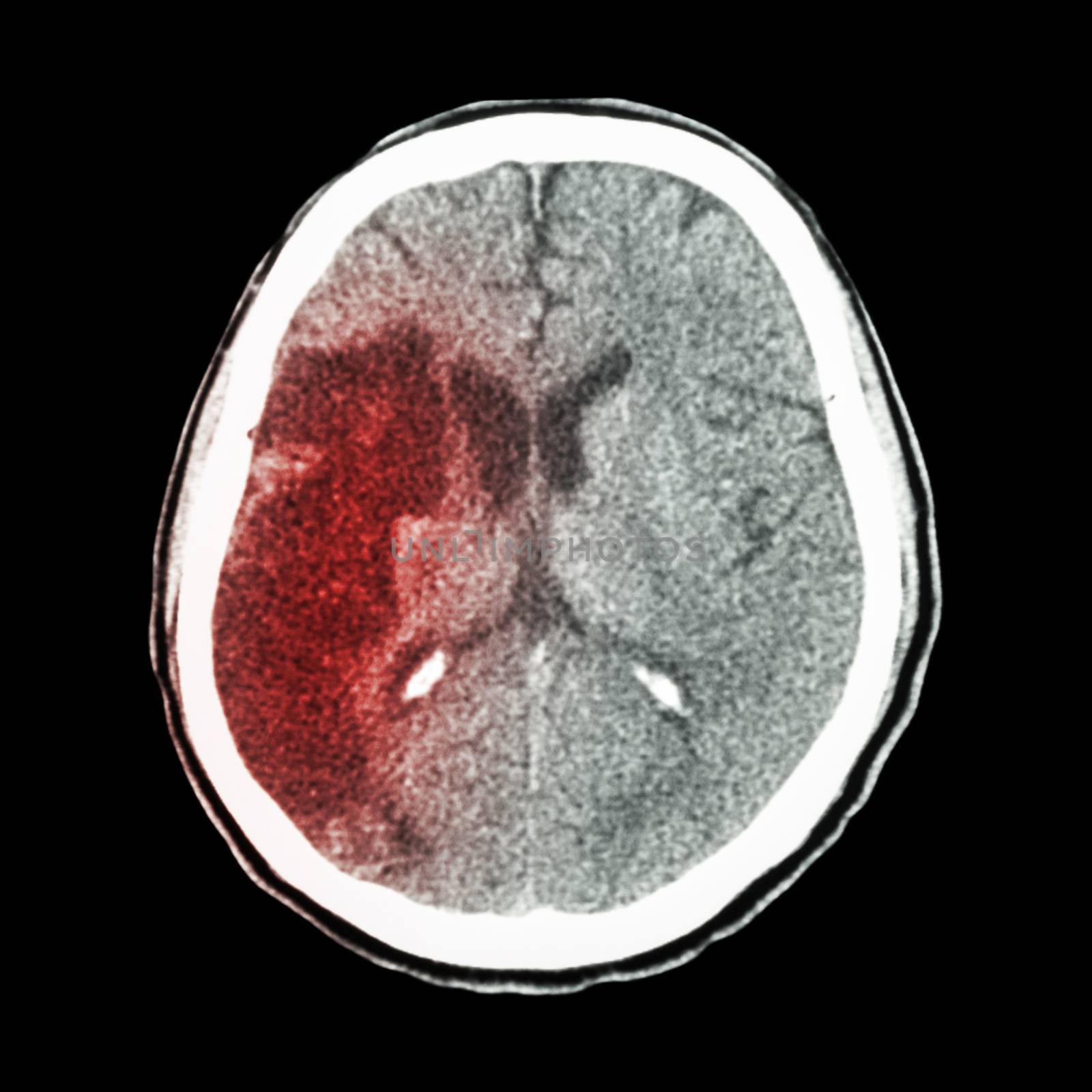 CT brain : show Ischemic stroke (hypodensity at right frontal-pa by stockdevil