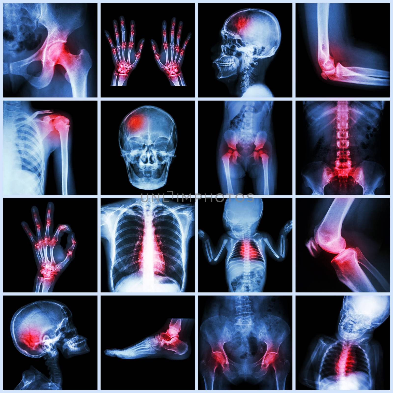 Collection X-ray multiple part of human and Arthritis,multiple disease (Gout , Rheumatoid,congenital heart disease,stroke) by stockdevil