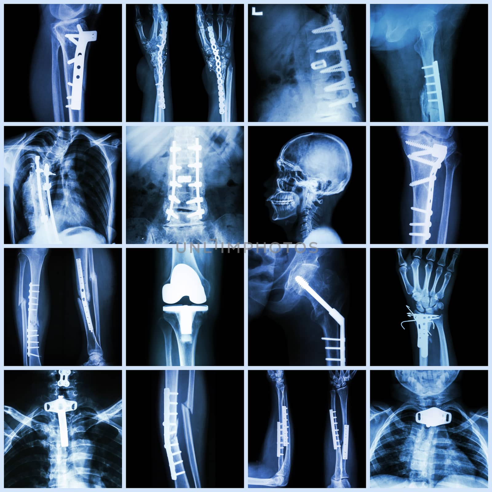 Collection X-ray orthopedic surgery (Multiple part of human, operate and internal fixation by plate&screw ) by stockdevil