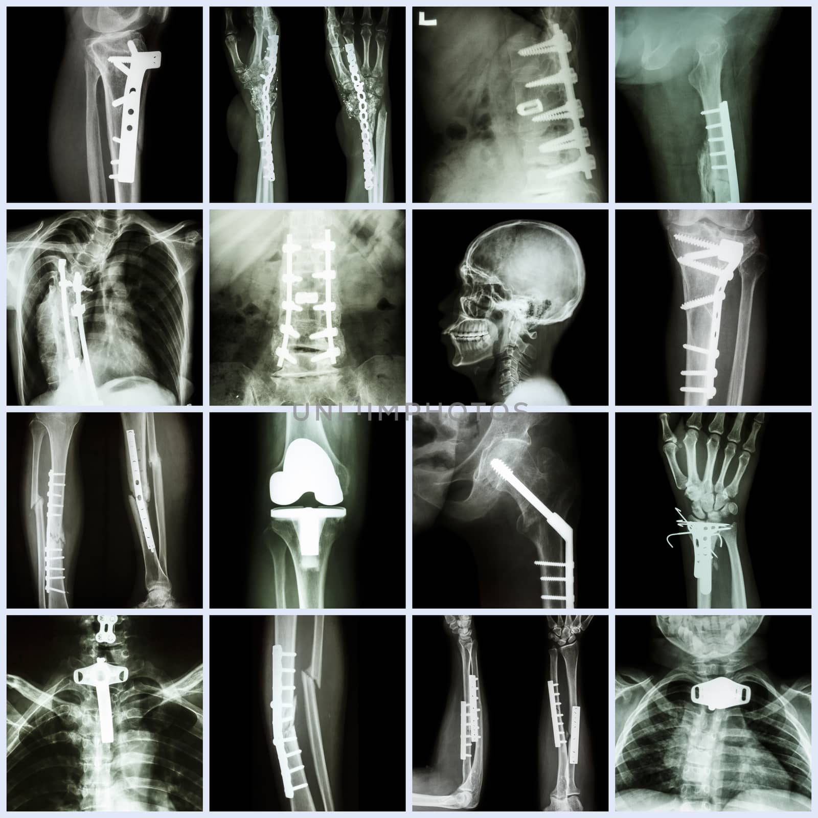 Collection X-ray orthopedic surgery (Multiple part of human, operate and internal fixation by plate&screw )