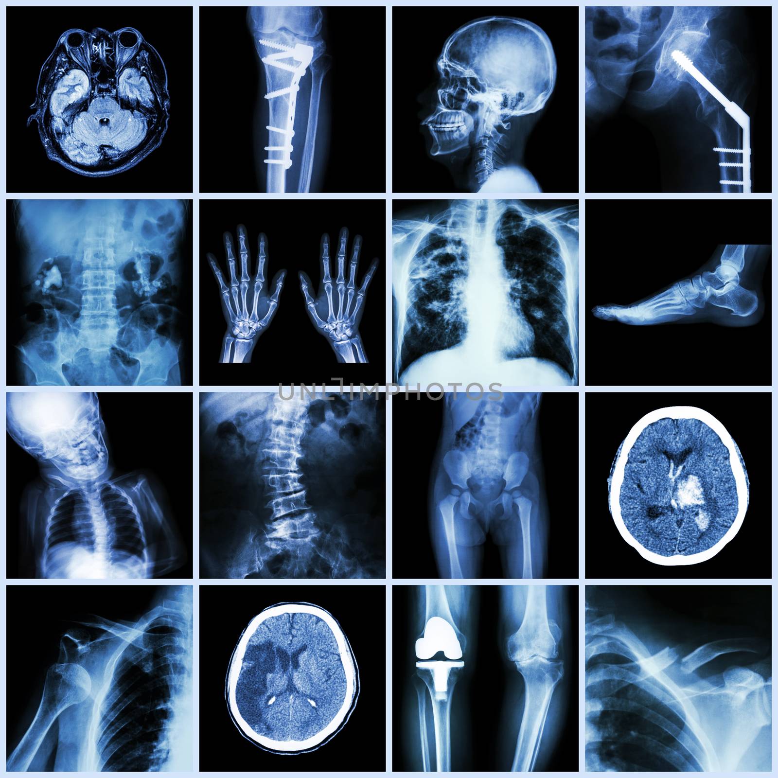 Set of X-ray multiple part of human,Multiple disease,orthopedic,surgery (Stroke,Bone fracture,Orthopedic operation,Kidney stone,Arthritis,Gout,Pulmonary tuberculosis,Heart disease,Scoliosis,etc) by stockdevil