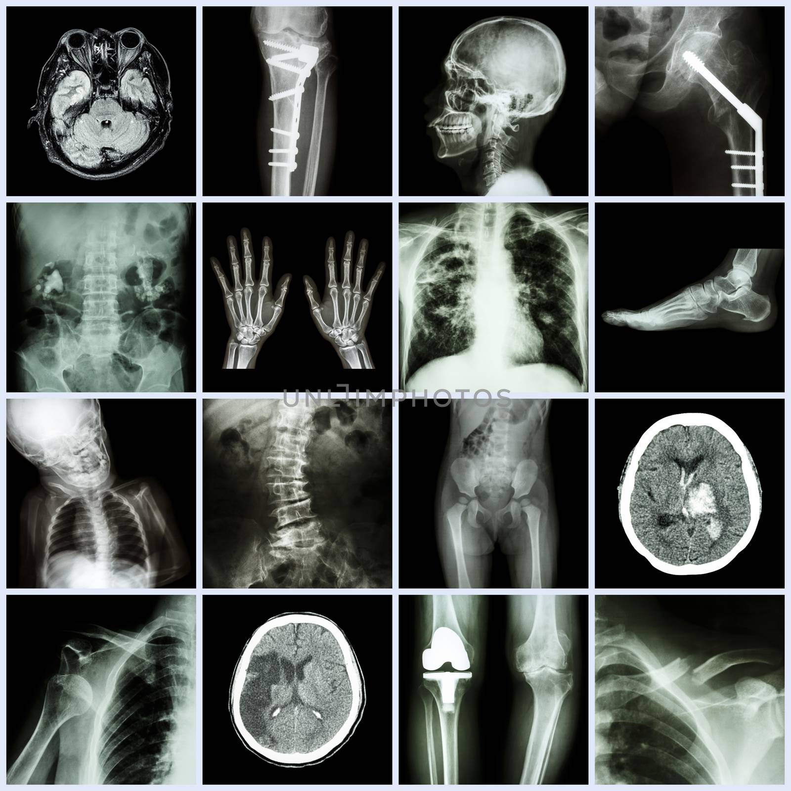 Set of X-ray multiple part of human,Multiple disease,orthopedic,surgery (Stroke,Bone fracture,Orthopedic operation,Kidney stone,Arthritis,Gout,Pulmonary tuberculosis,Heart disease,Scoliosis,etc) by stockdevil