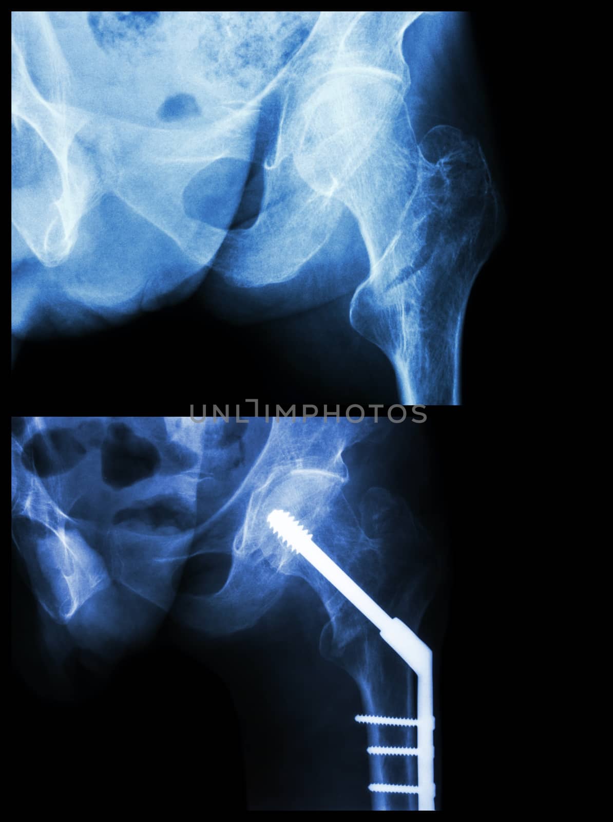 Intertrochanteric fracture left femur (fracture thigh's bone). It was operated and insert intramedullary nail.