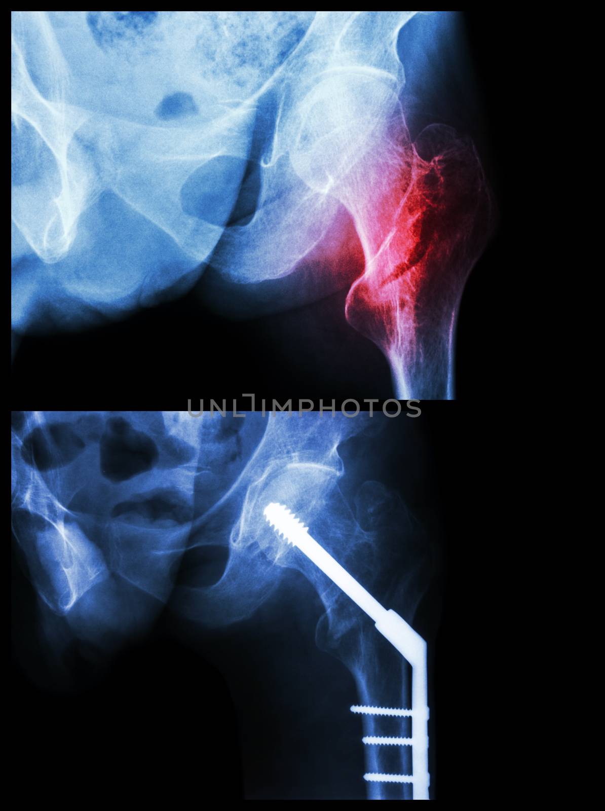 Intertrochanteric fracture left femur (fracture thigh's bone). It was operated and inserted intramedullary nail.