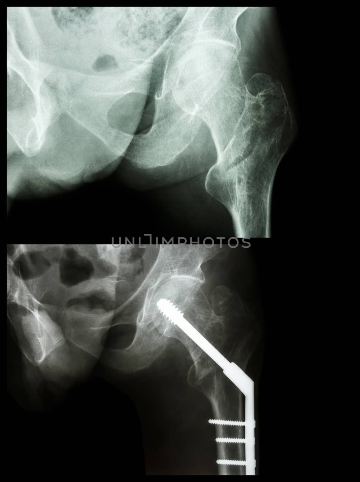 Intertrochanteric fracture left femur (fracture thigh's bone). It was operated and insert intramedullary nail.