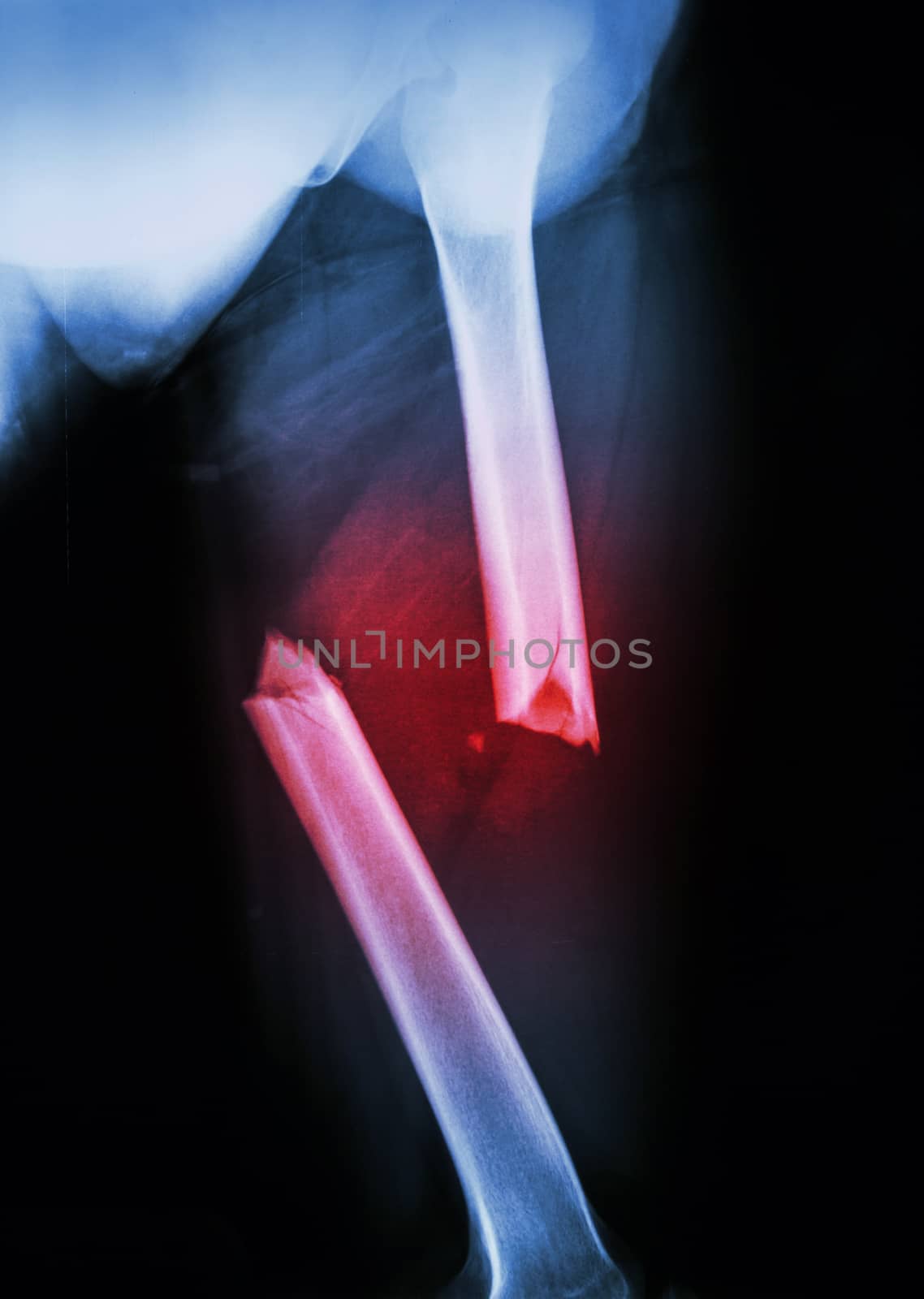 Film X-ray Left femur(left thigh) show complete fracture shaft of femur and displace