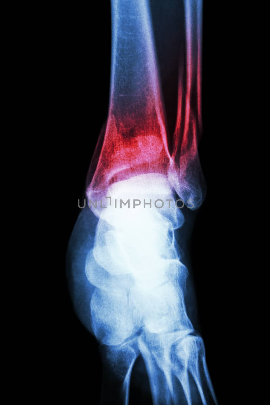 film x-ray ankle show fracture distal tibia and fibula (leg's bone)