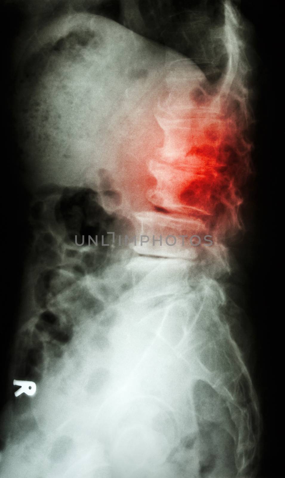 "Spondylolisthesis" film x-ray L-S spine lateral (lumbar-sacrum) of old aged patient