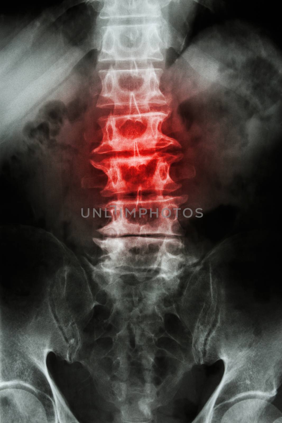 "Spondylosis" film x-ray L-S spine (lumbar-sacrum) of old aged patient and inflammation at spine