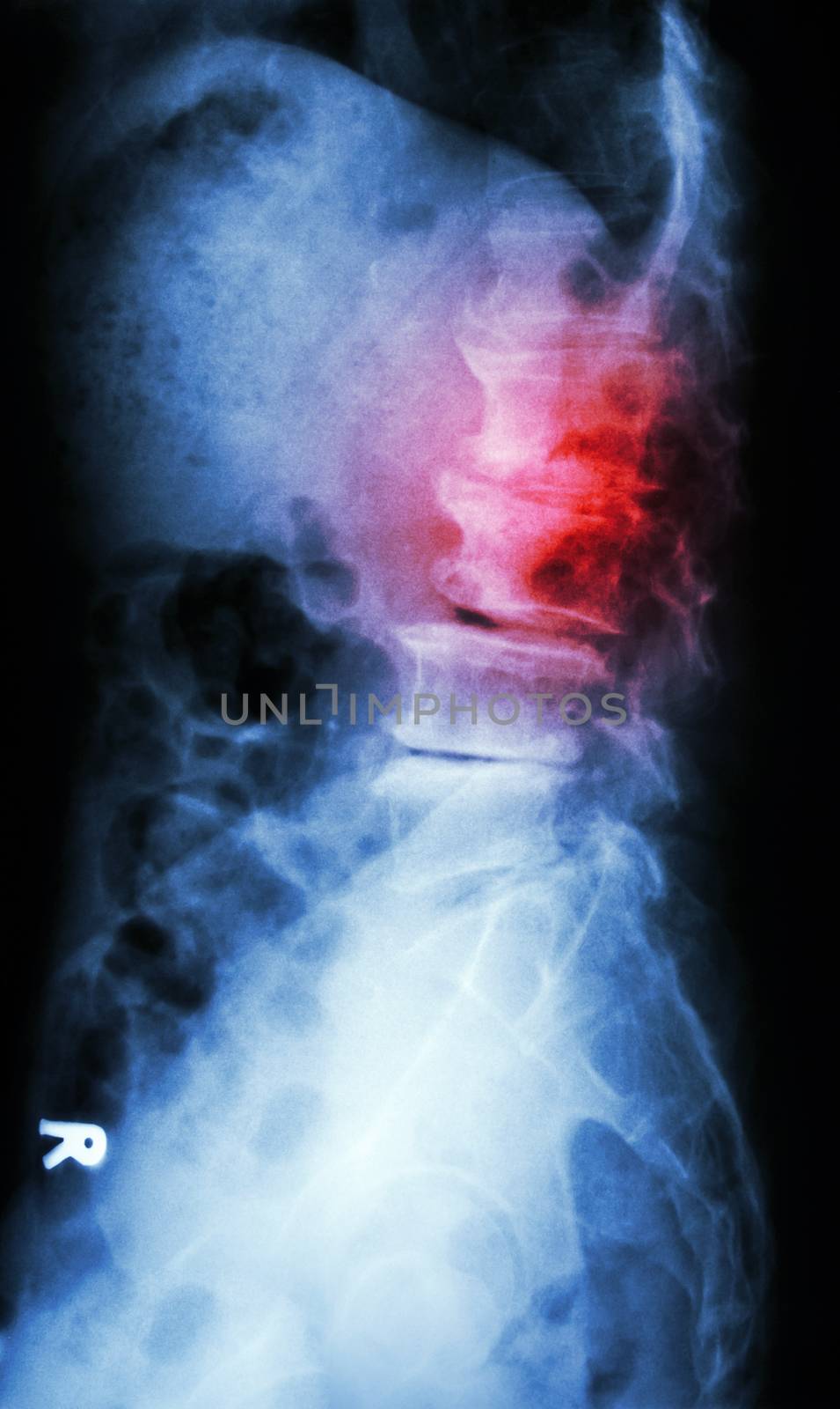 "Spondylolisthesis" film x-ray L-S spine lateral (lumbar-sacrum) of old aged patient