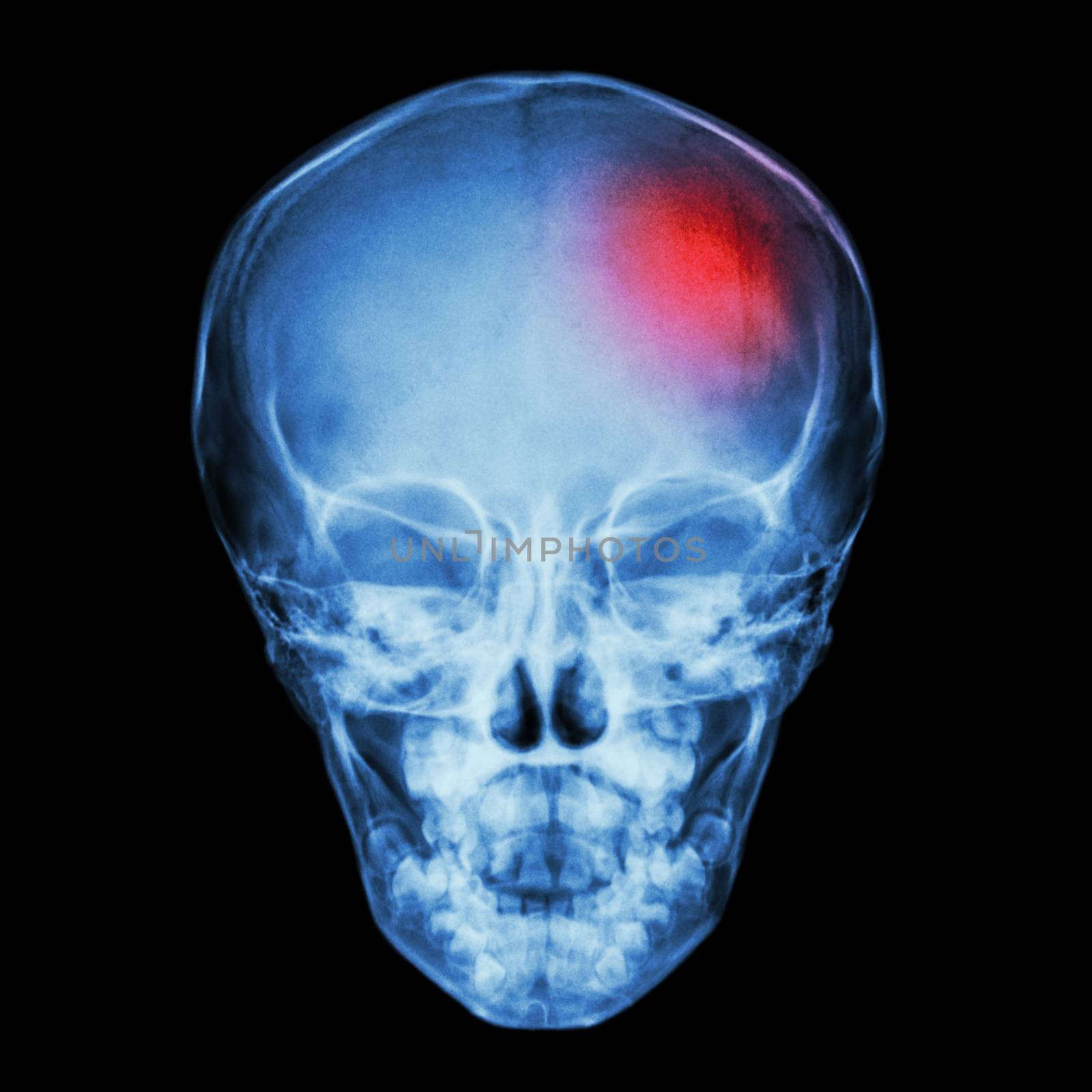 X-ray Skull of child and Stroke (cerebrovascular accident) by stockdevil