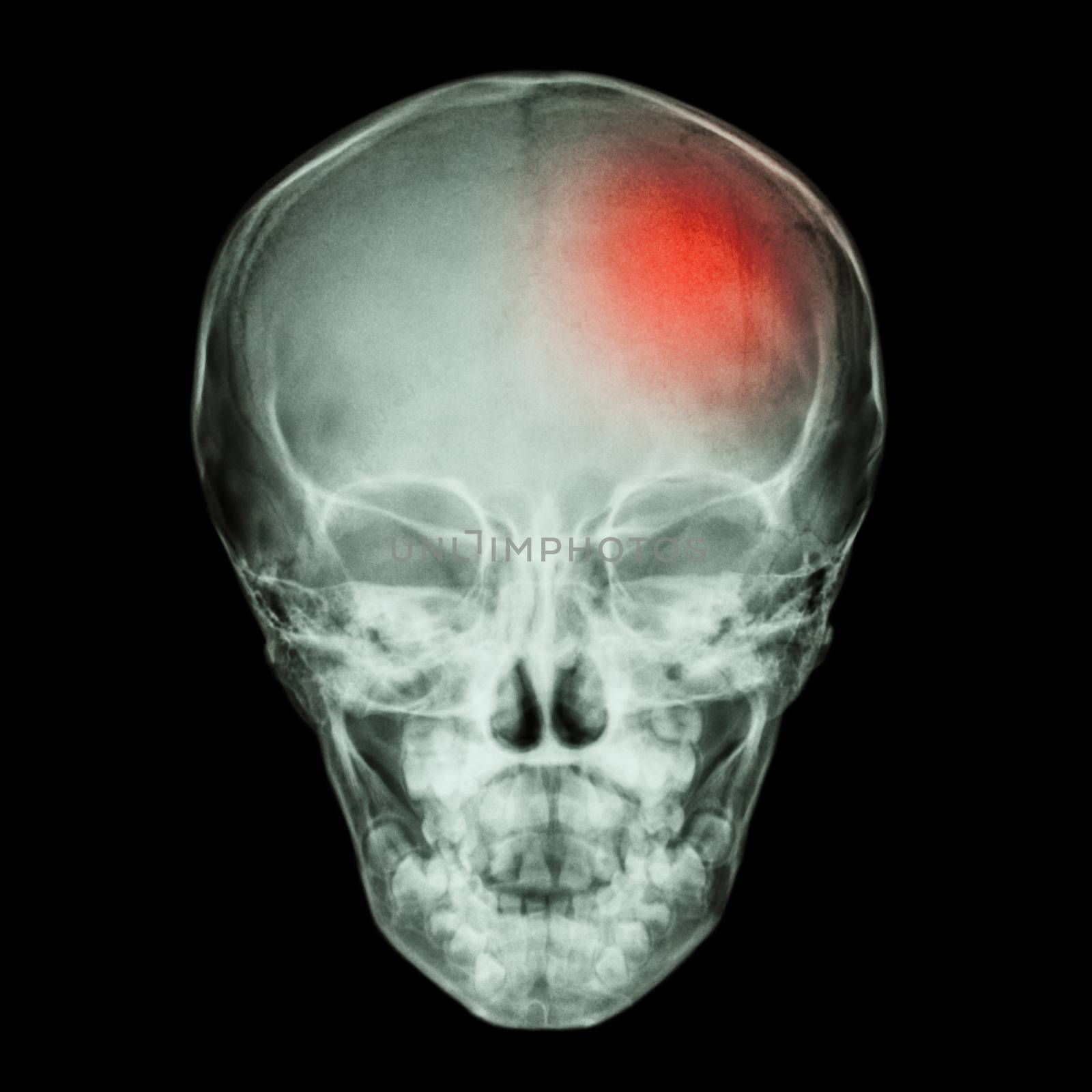 X-ray Skull of child and Stroke (cerebrovascular accident) by stockdevil