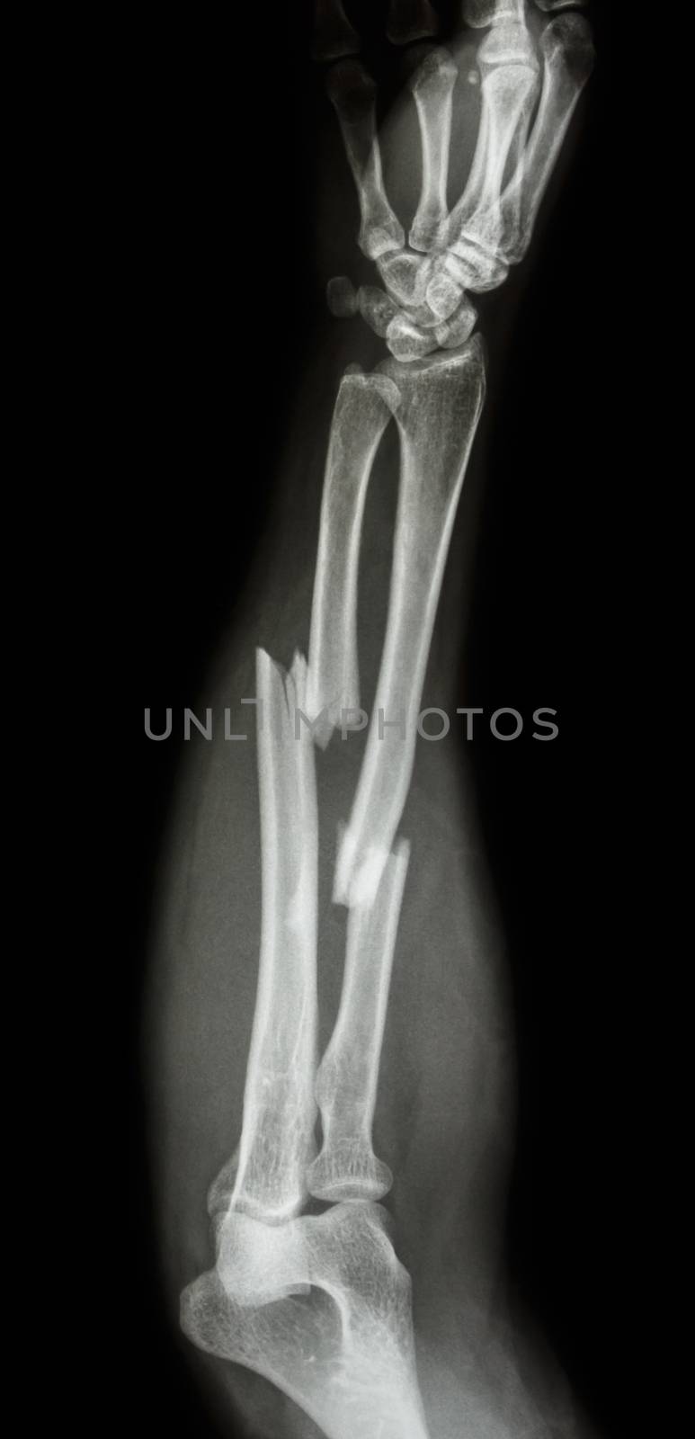 fracture shaft of radius & ulnar bone