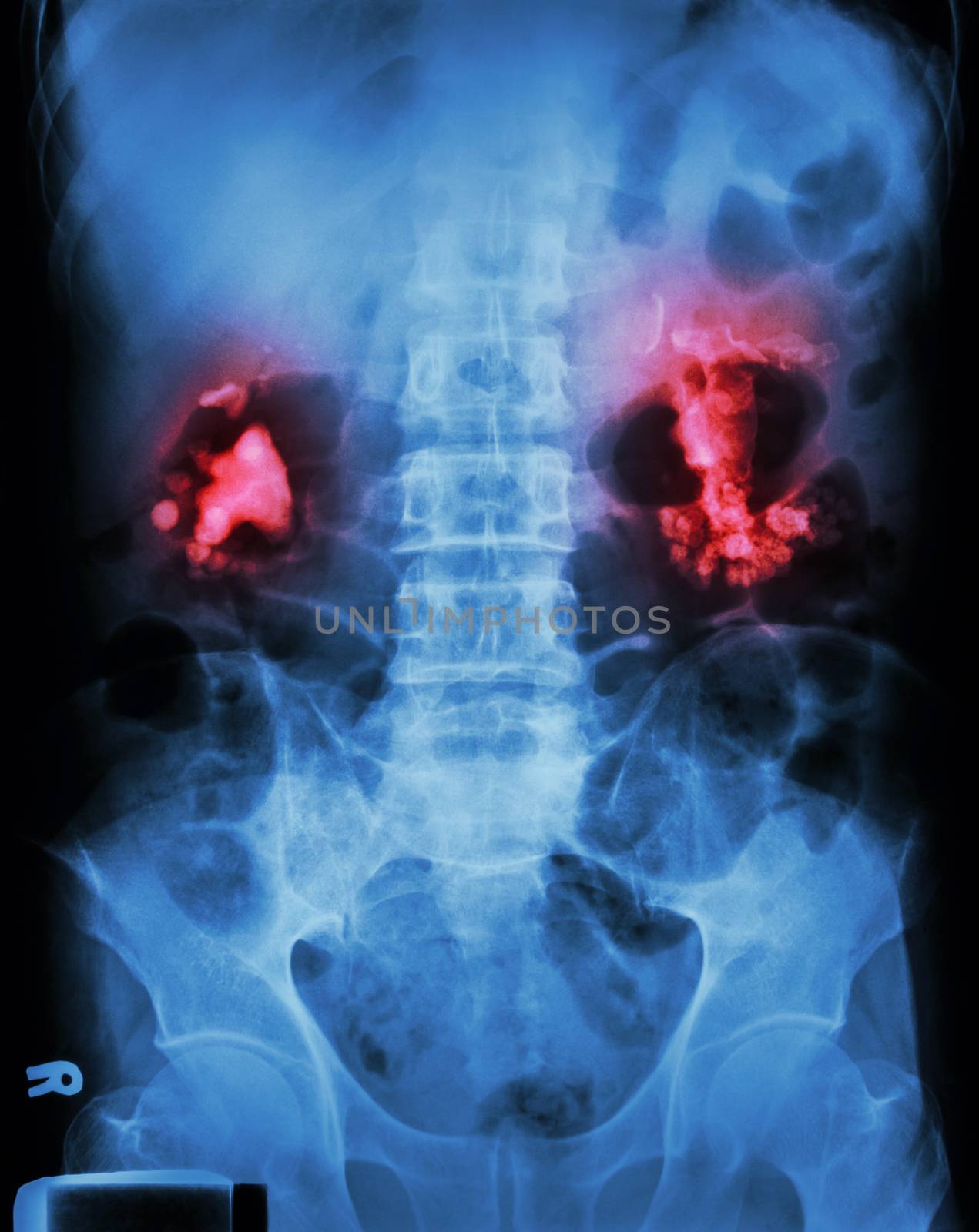 Bilateral renal calculi(staghorn)