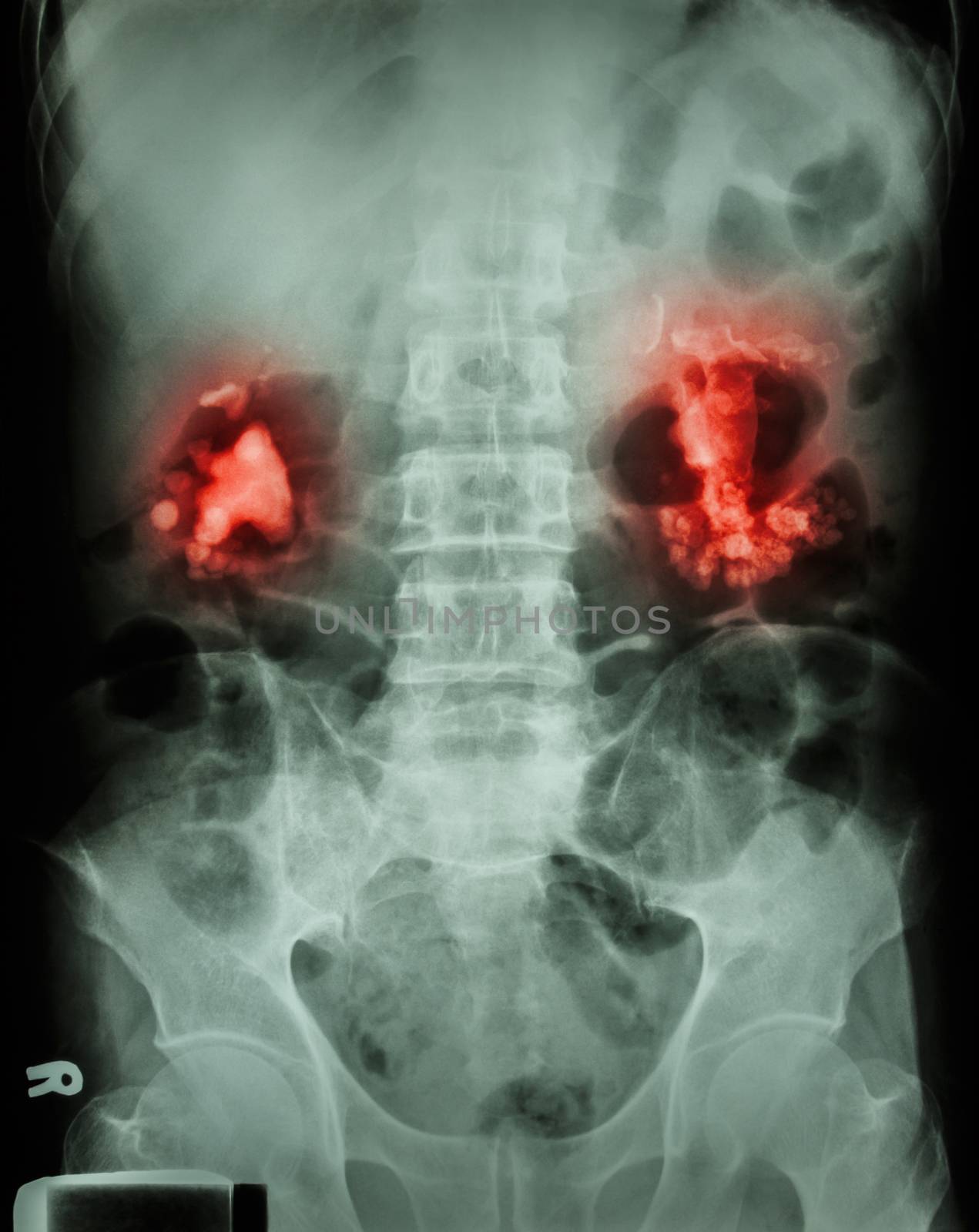 Bilateral renal calculi(staghorn)