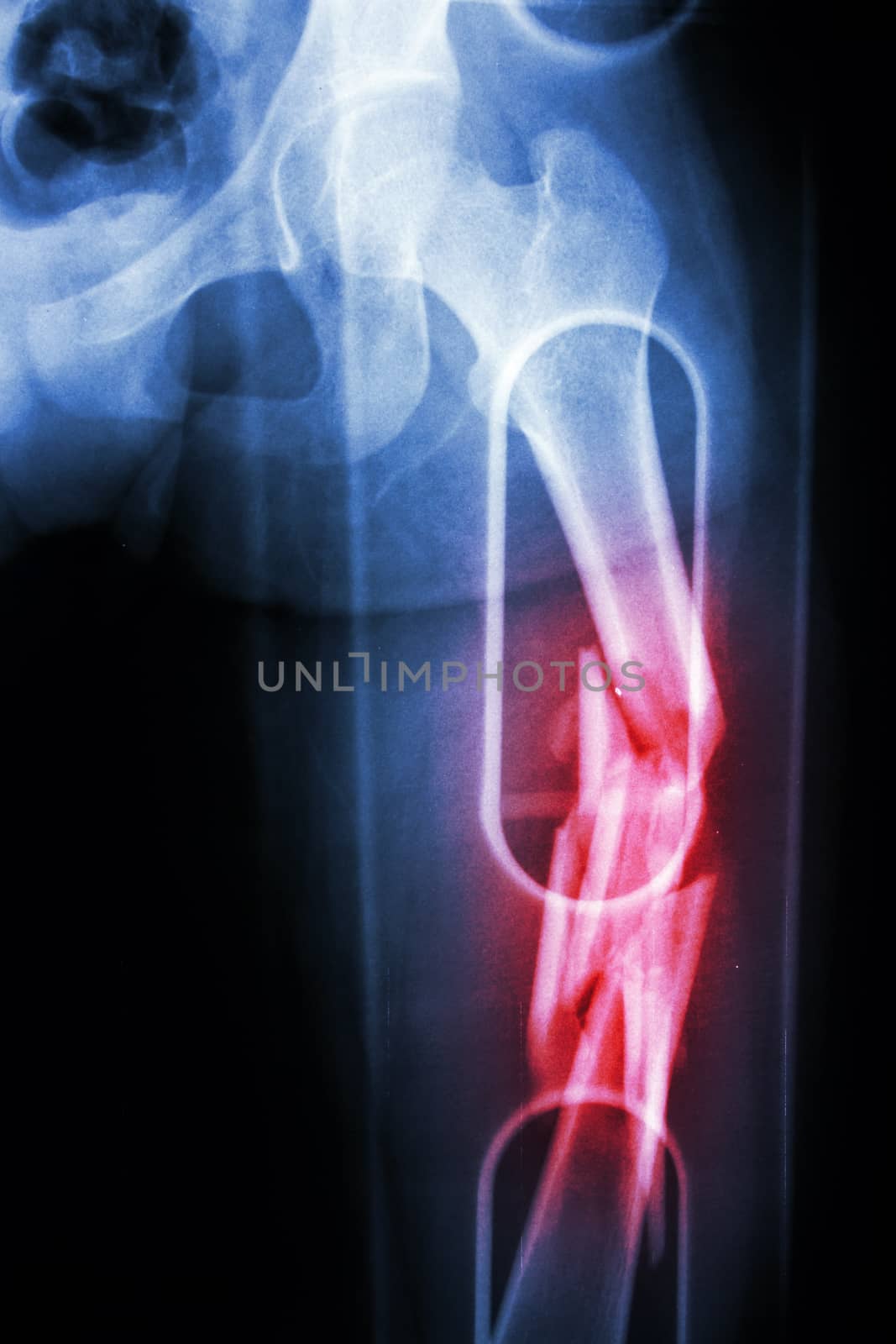 Film X-ray show comminute fracture shaft of femur (thigh bone). It was spliced