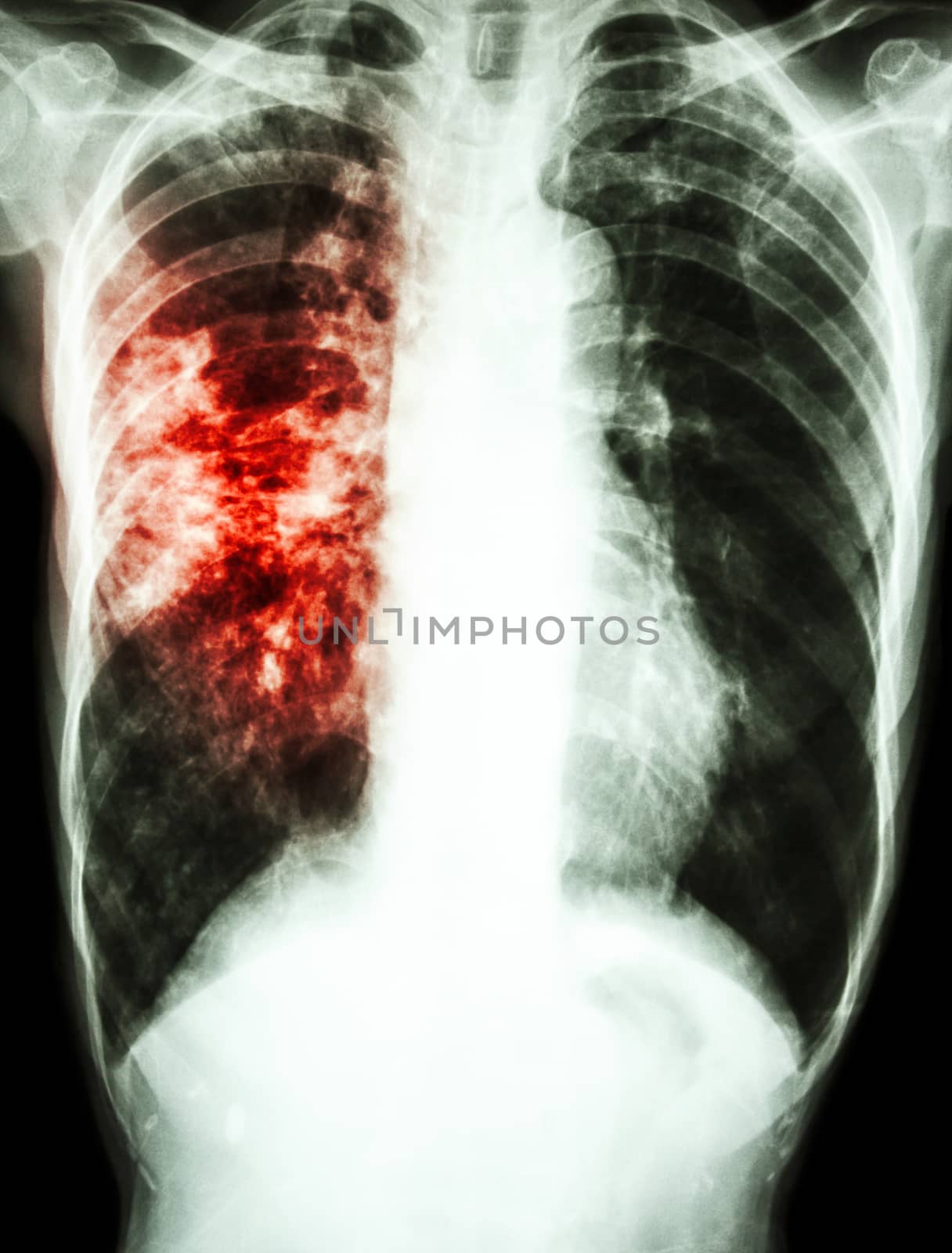 film chest x-ray show alveolar infiltrate at right lung due to Mycobacterium tuberculosis infection (Pulmonary Tuberculosis)