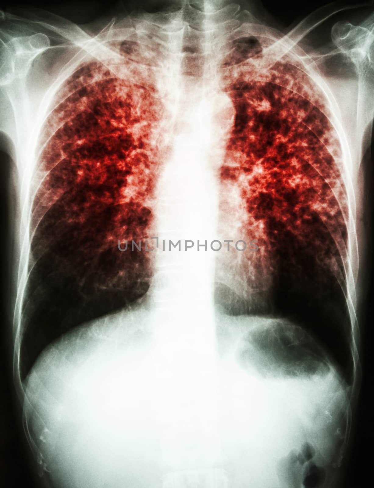 film chest x-ray show interstitial infiltrate both lung due to Mycobacterium tuberculosis infection (Pulmonary Tuberculosis)