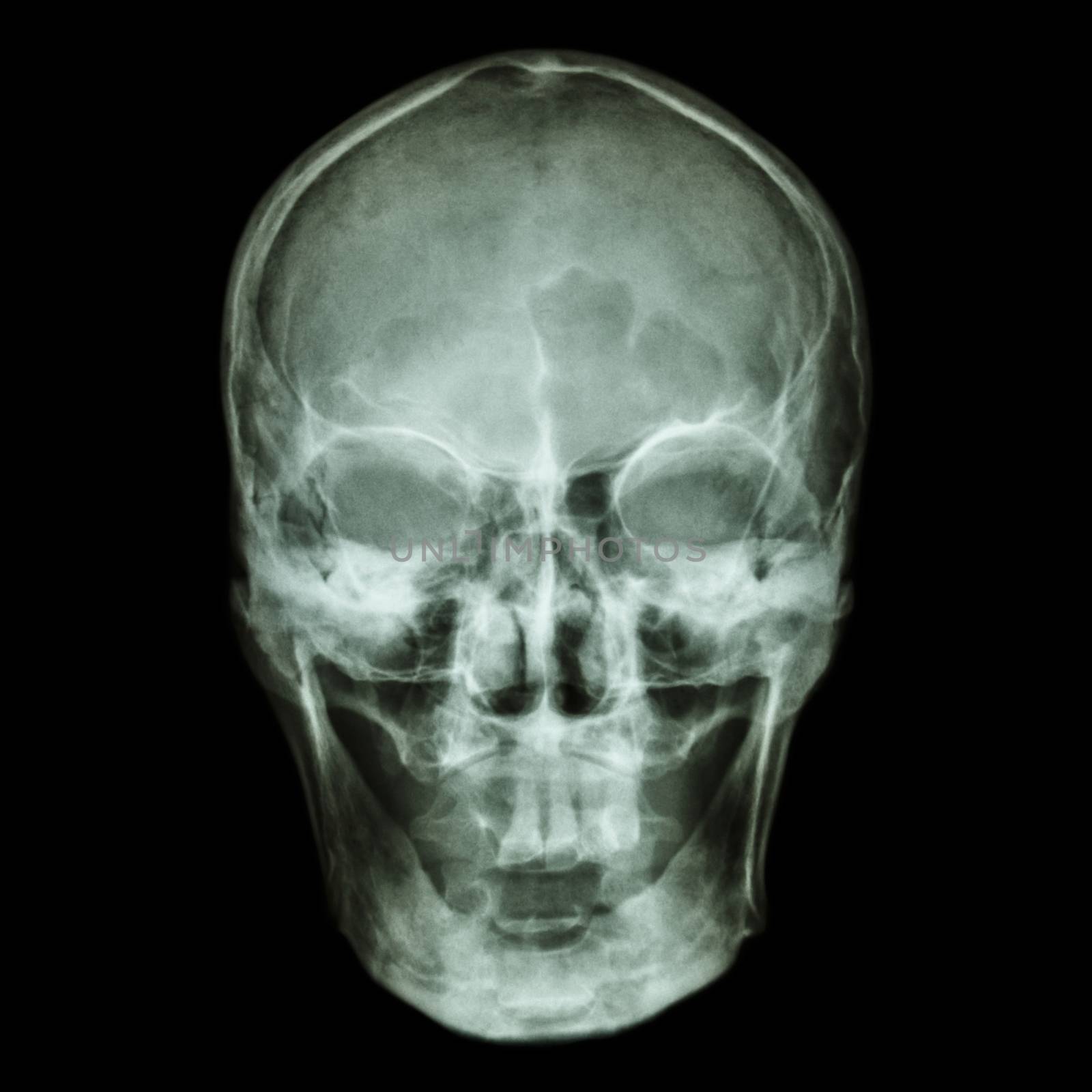 X-ray skull (Asian)