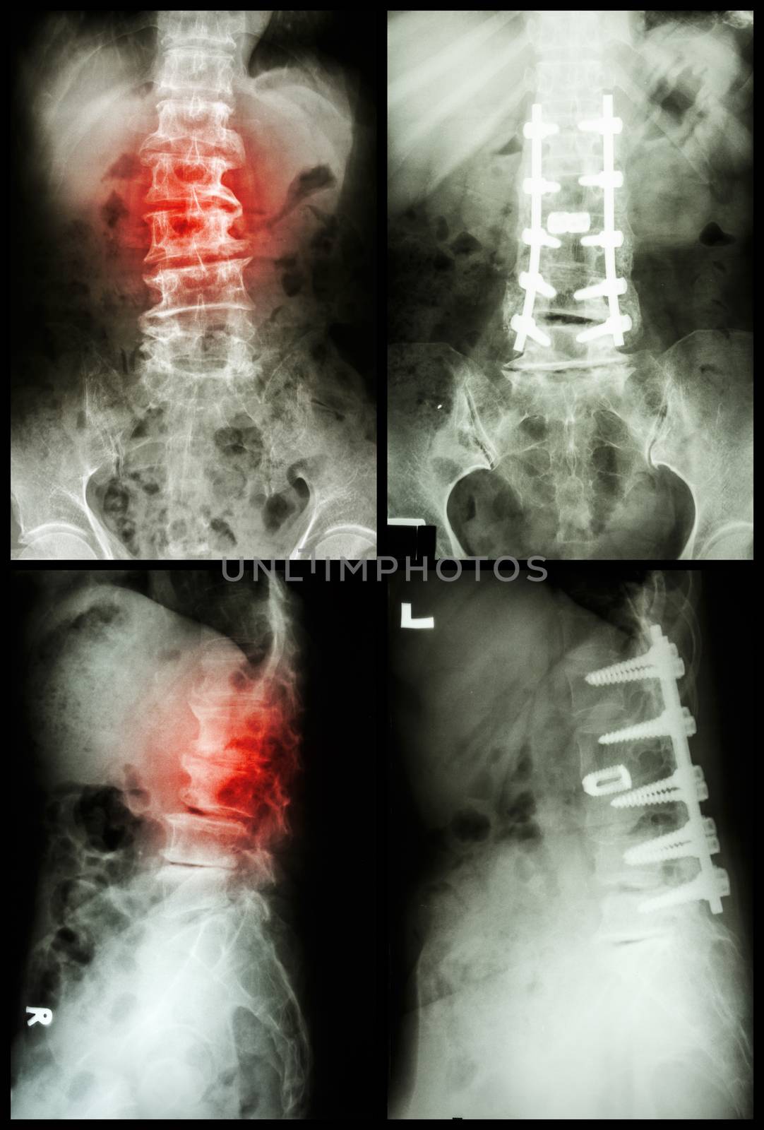 "Spondylosis and Spondylolisthesis" It was operated and internal fixed at spine (Left image : before operated) (Right image : after operated)