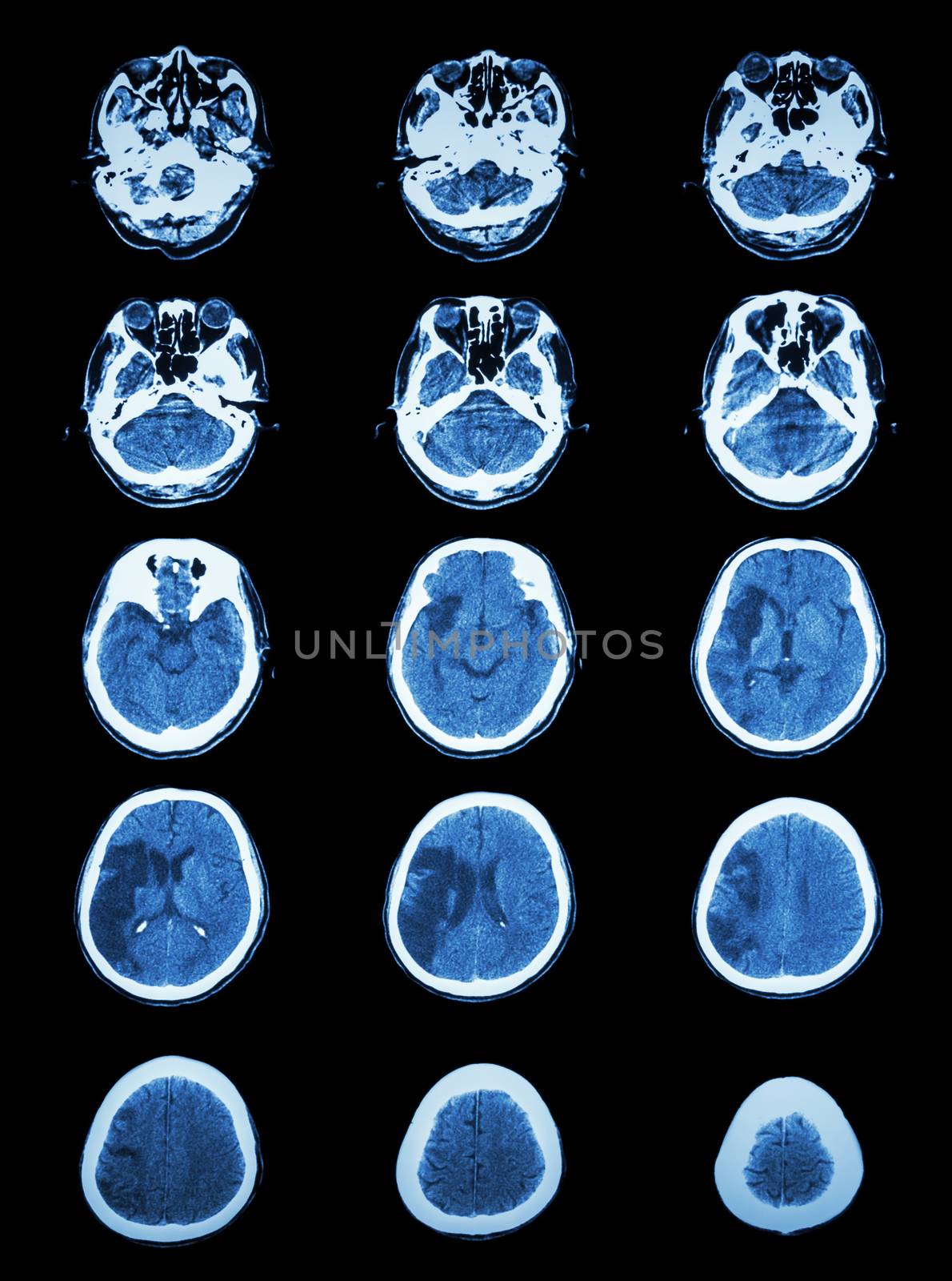 CT scan (computed tomography) of brain show cerebral infarction at right temporal-parietal lobe ( ischemic stroke )