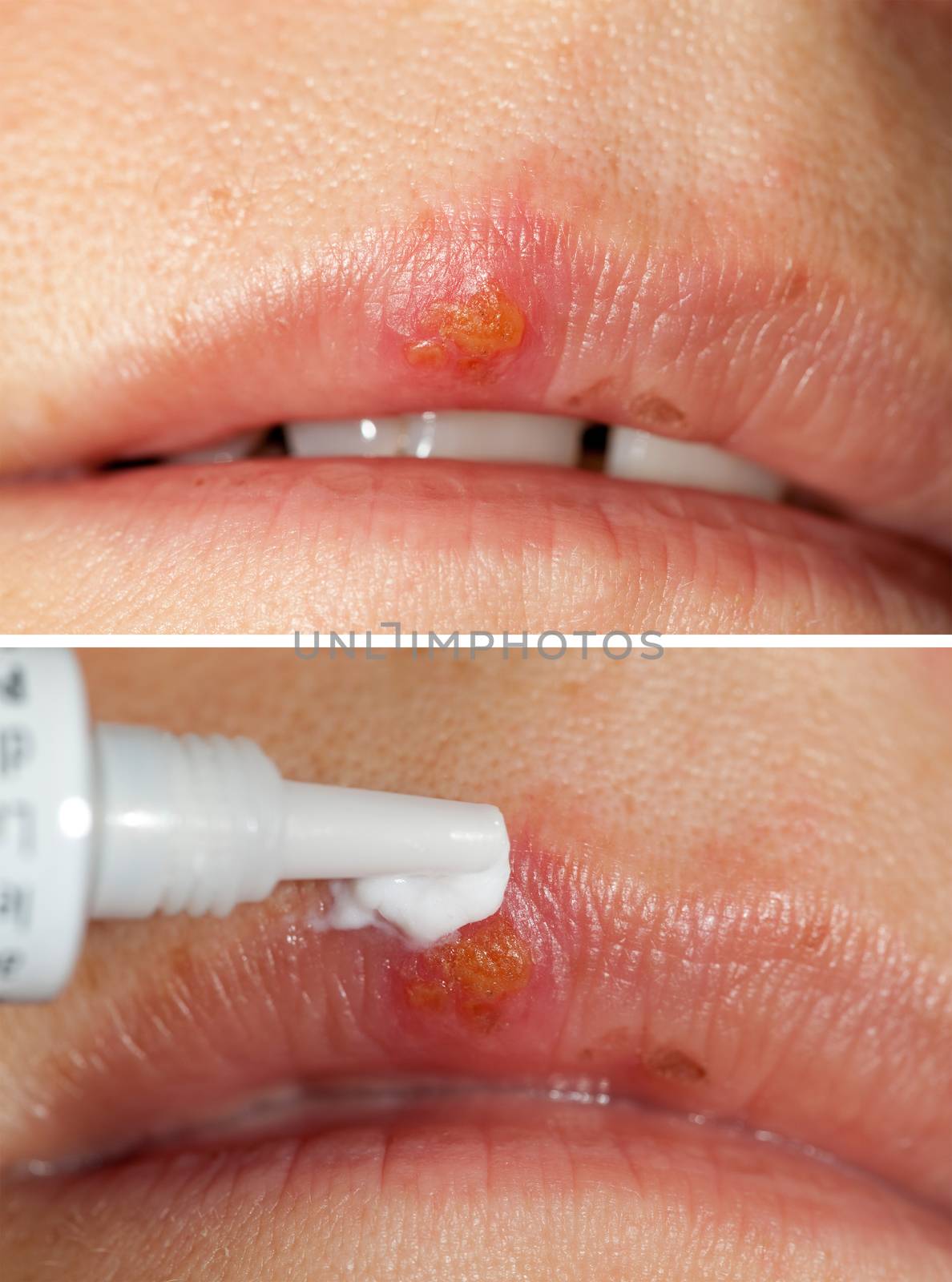 cold sore on mouth to be treatment ointment      