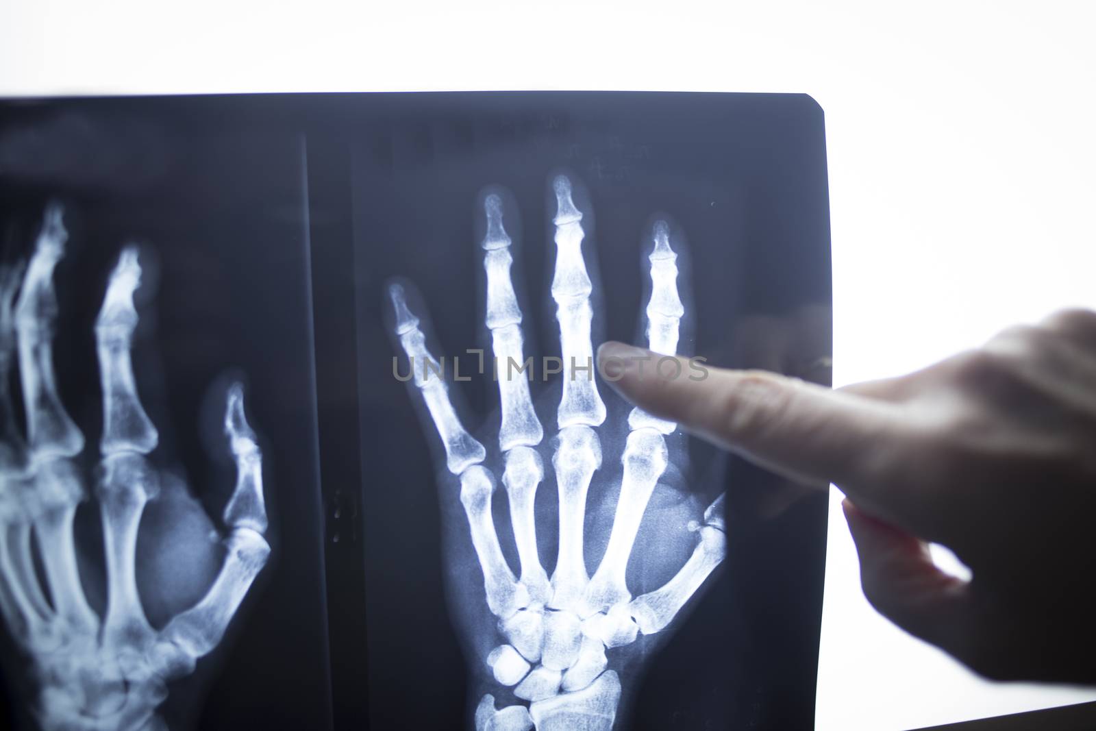 Female medical doctor pointing with finger at radiograph x-ray image on viewing light screen monitor showing hand of patient in scan.