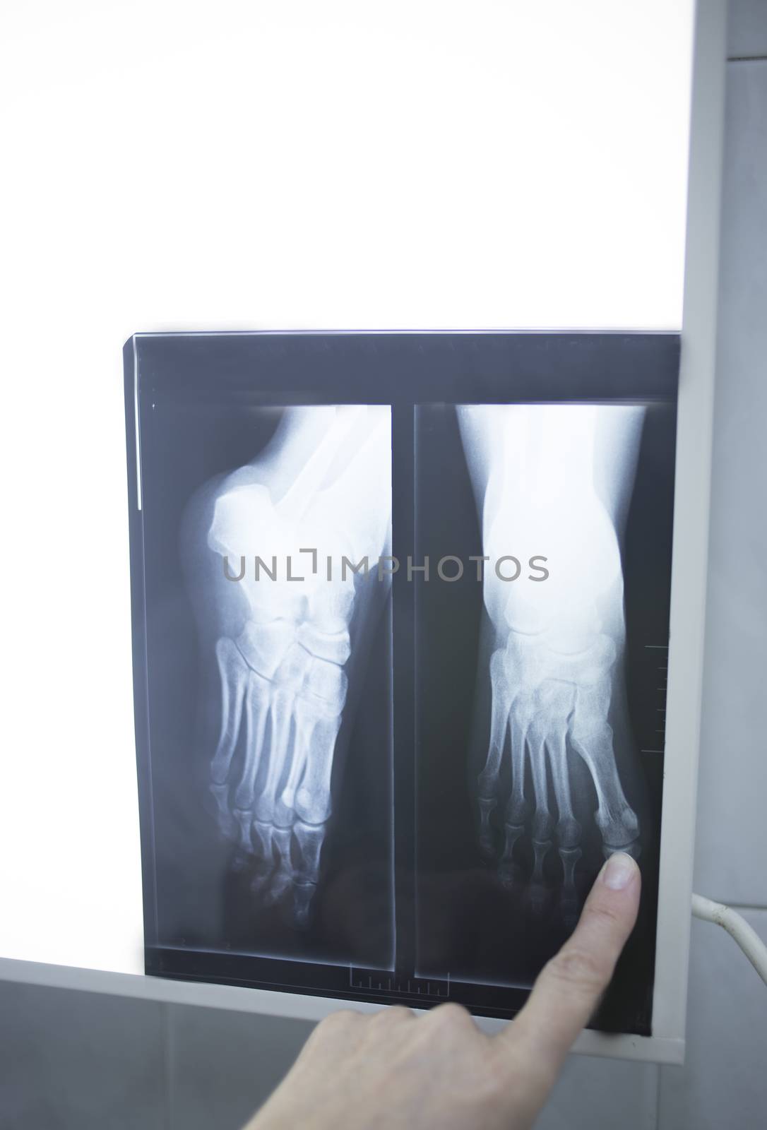 Female medical doctor pointing with finger at radiograph x-ray image on viewing light screen monitor showing hand of patient in scan.