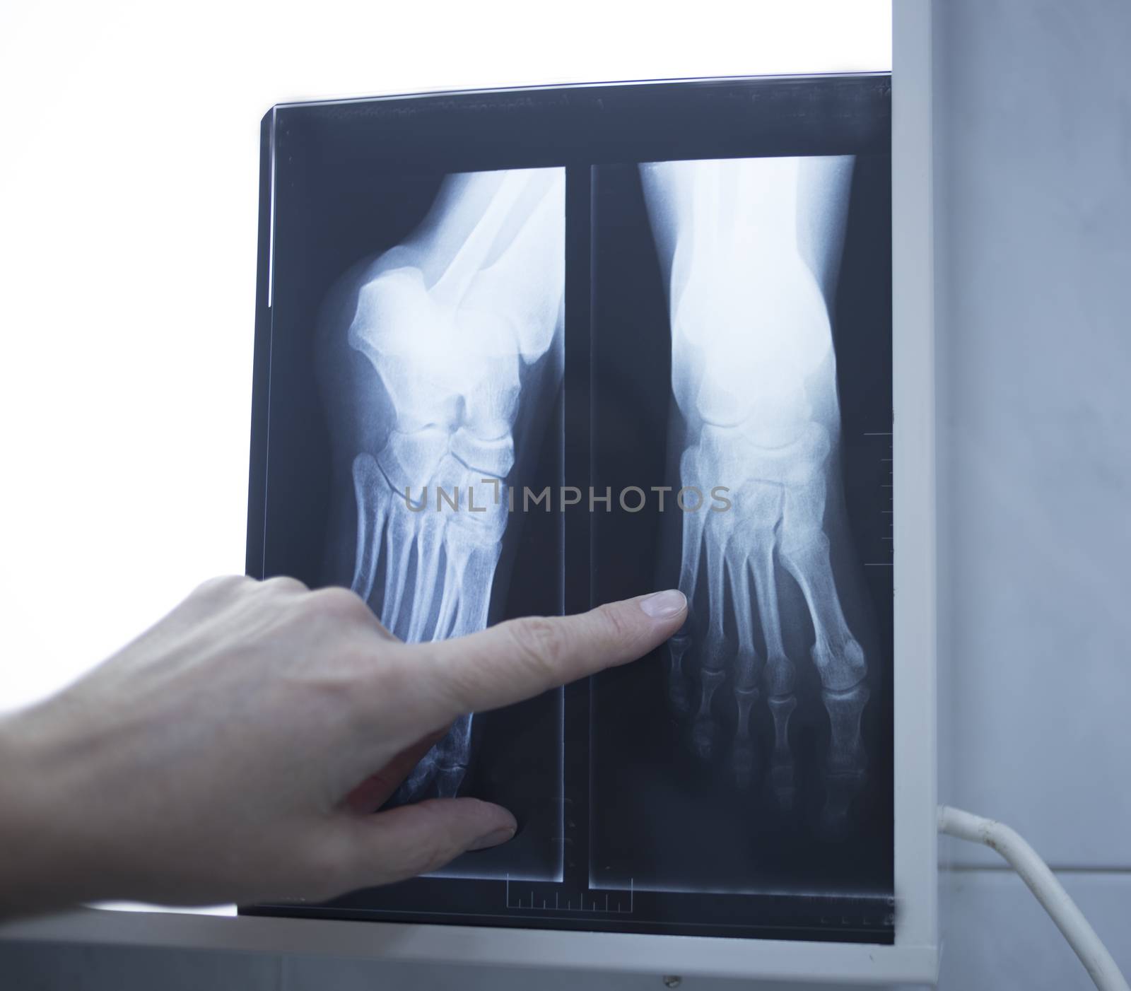 Female medical doctor pointing with finger at radiograph x-ray image on viewing light screen monitor showing hand of patient in scan.