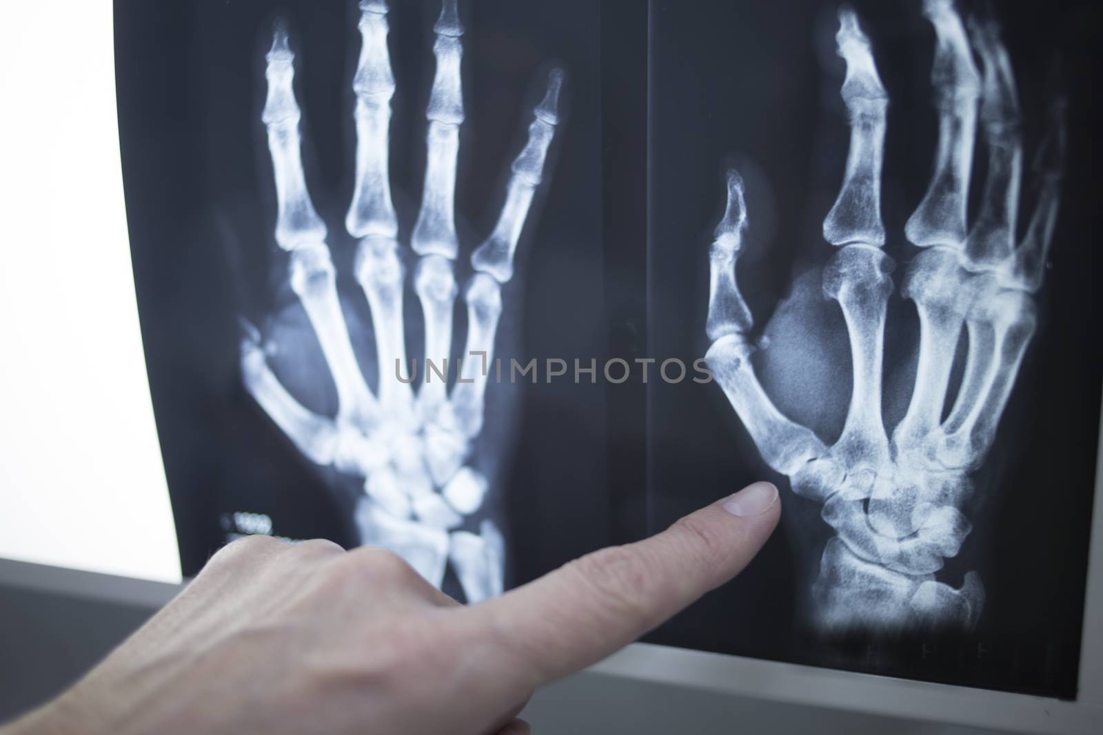 Medical doctor pointing at radiograph x-ray image by edwardolive