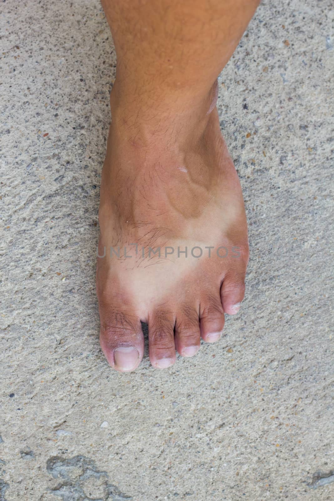 tanned foot when he wears sandal in sunshine for long time by a3701027