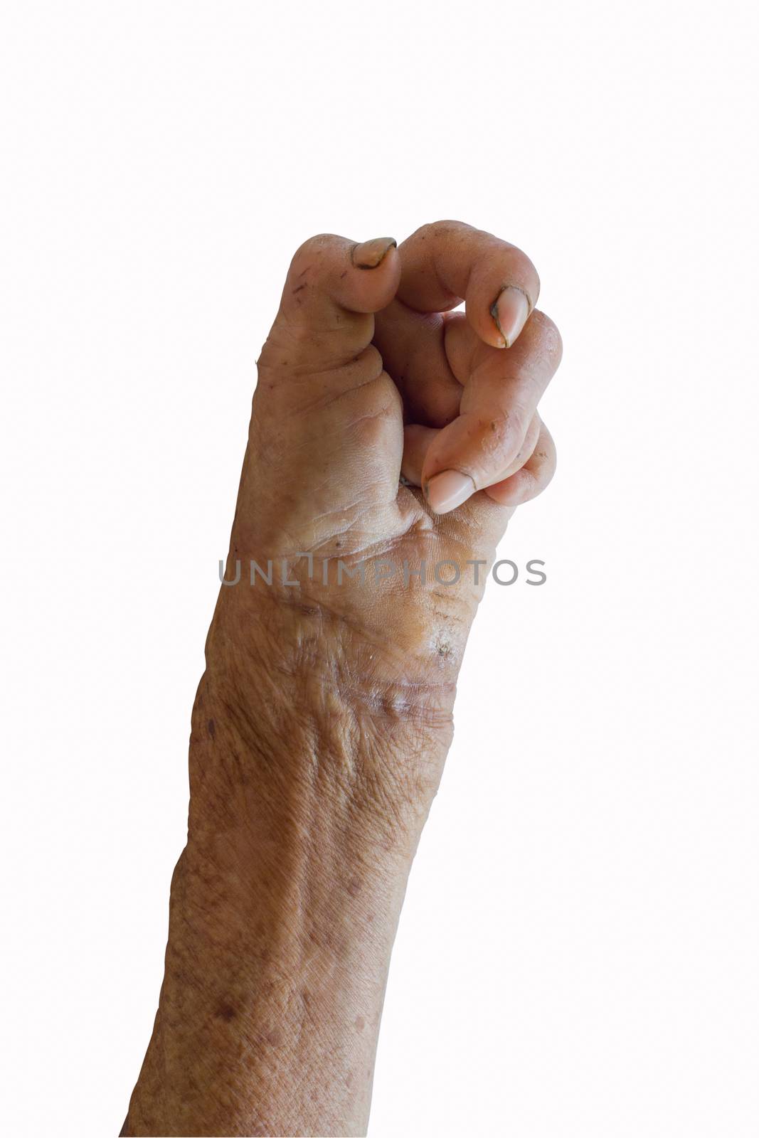 left hand of a leprosy by a3701027