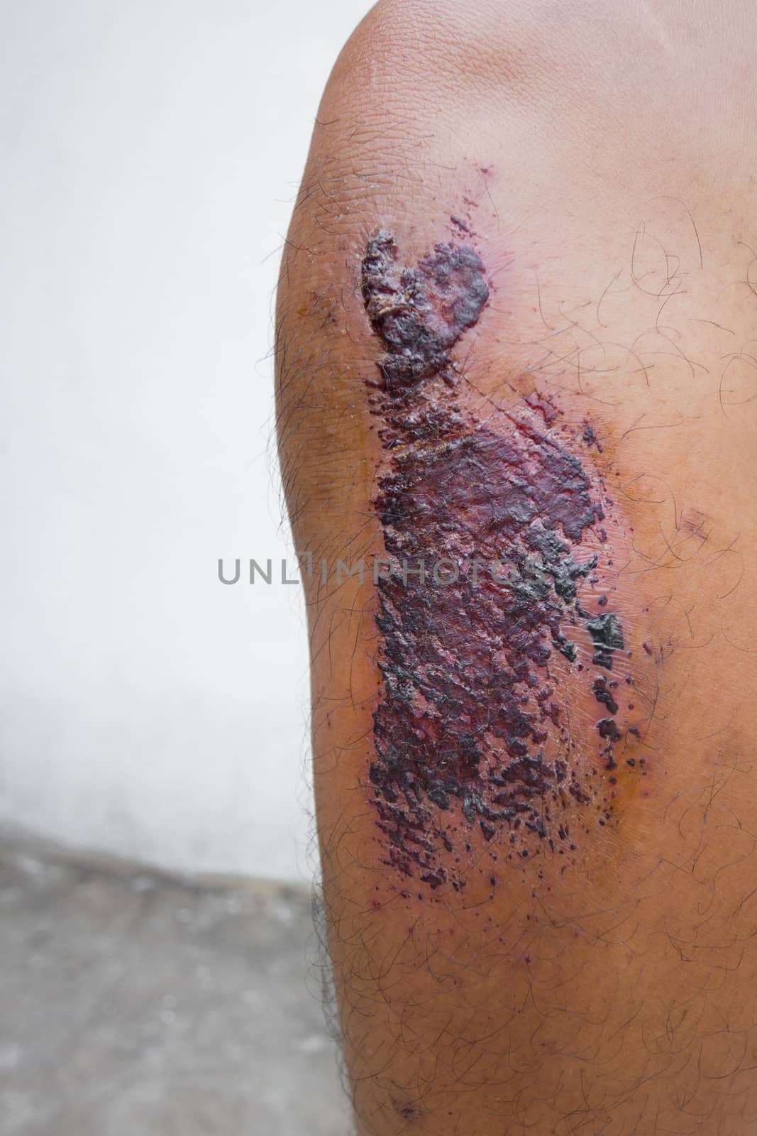 scab skin of patient's knee