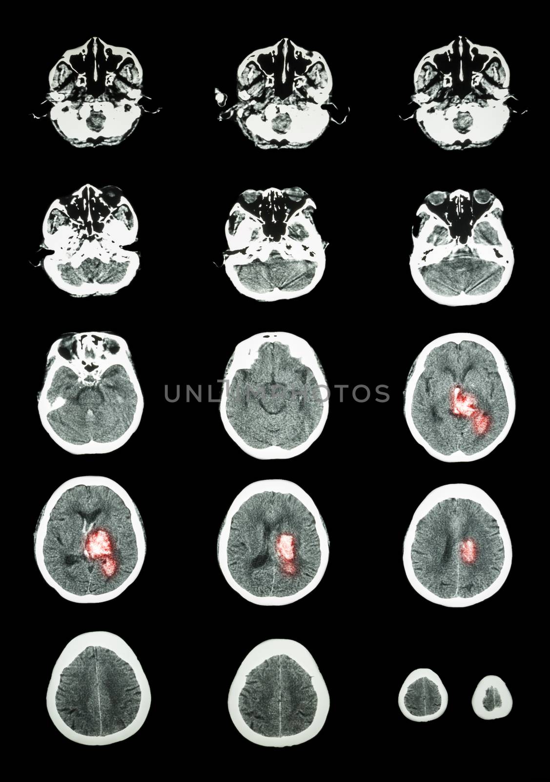 Hemorrhagic Stroke . CT scan (computed tomography) of brain ( cerebrovascular system ) : Intracerebral hemorrhage at left cerebral hemisphere
