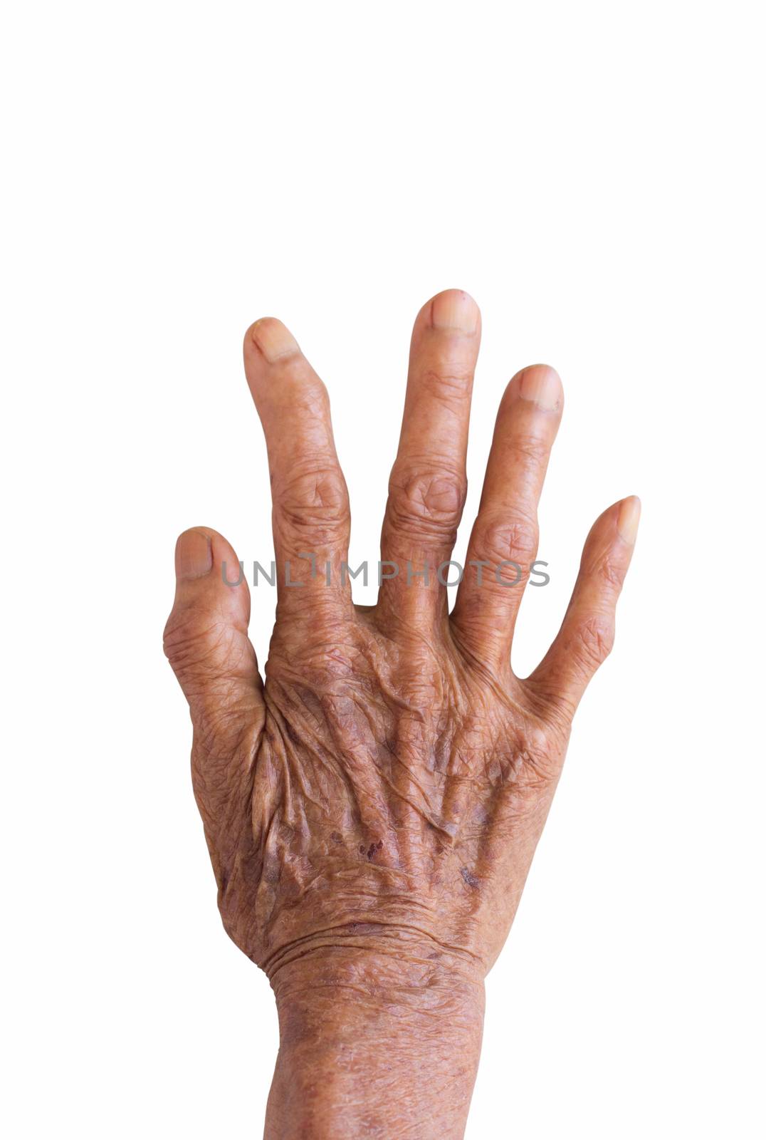 right hand of a leprosy isolated on white background