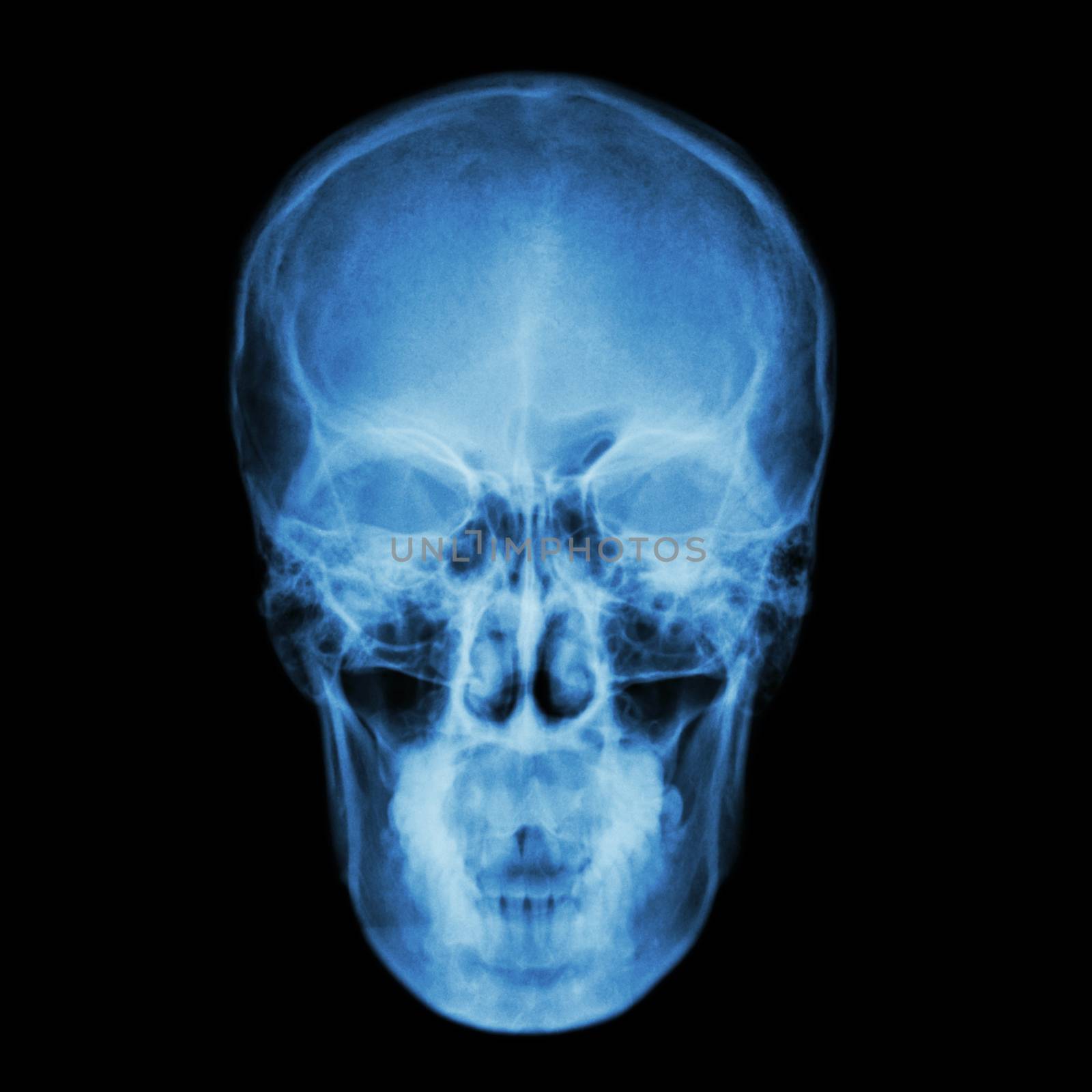 X-ray skull and Stroke ( cerebrovascular accident (CVA) ) by stockdevil