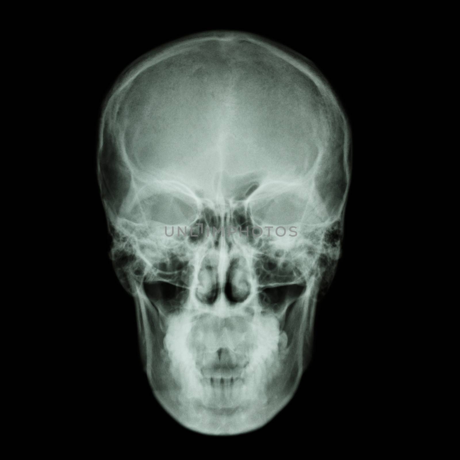 X-ray skull and Stroke ( cerebrovascular accident (CVA) )