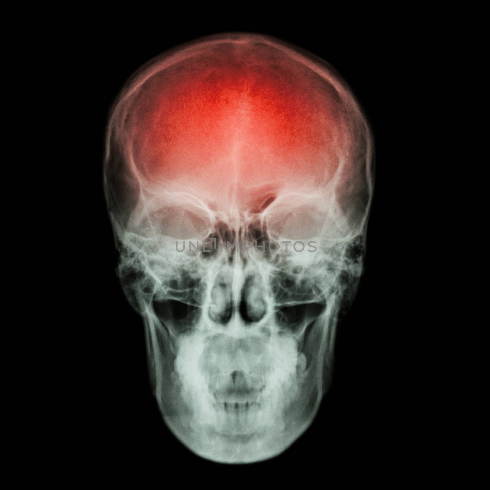 X-ray skull and Stroke ( cerebrovascular accident (CVA) ) by stockdevil
